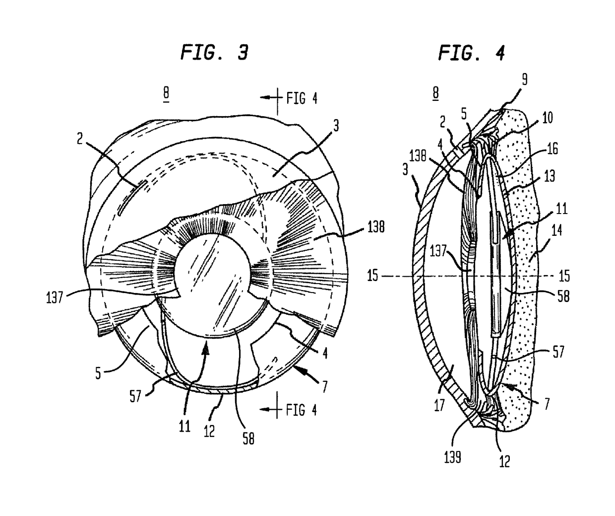 Micropatterned intraocular implant