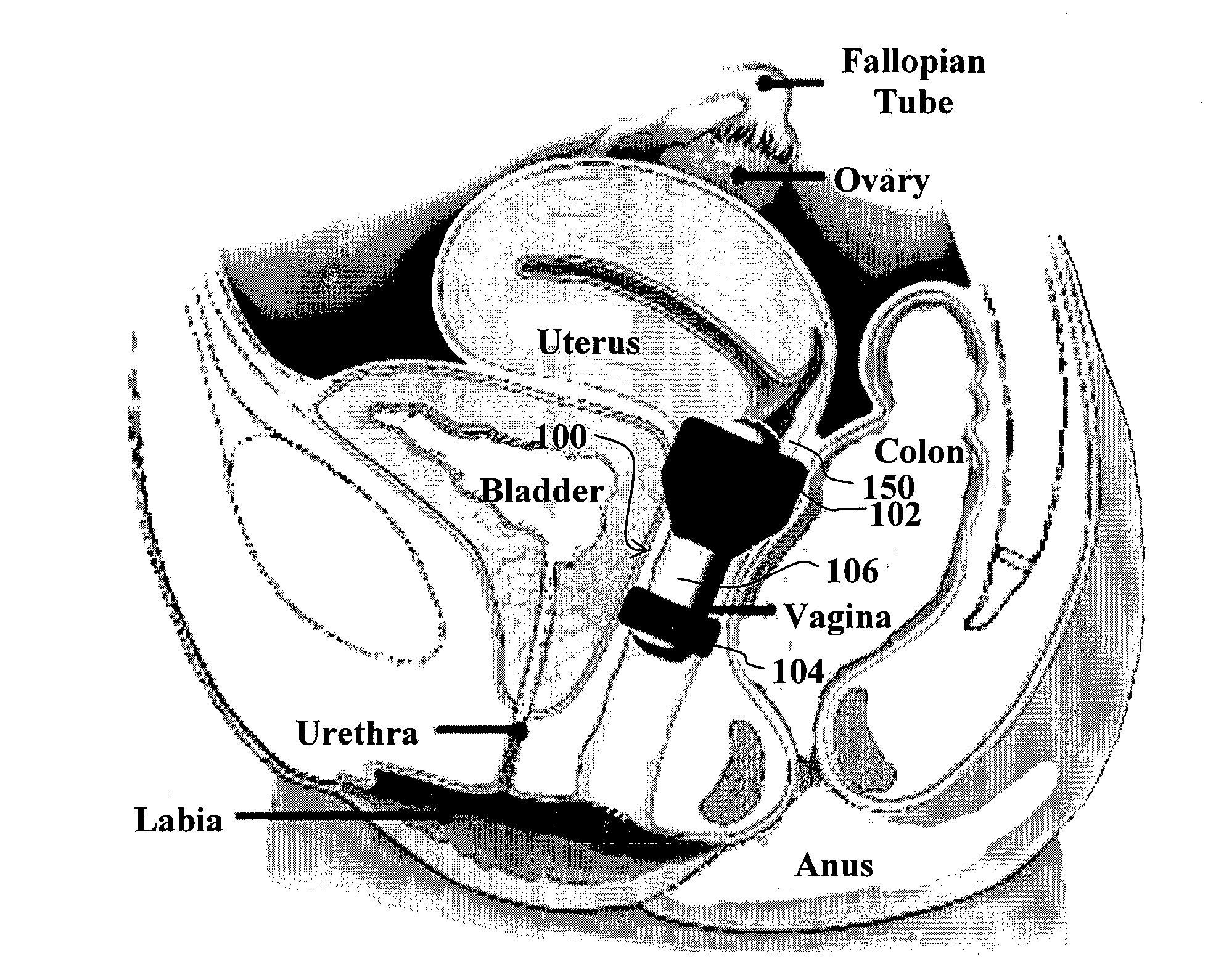 Female urinary incontinence device