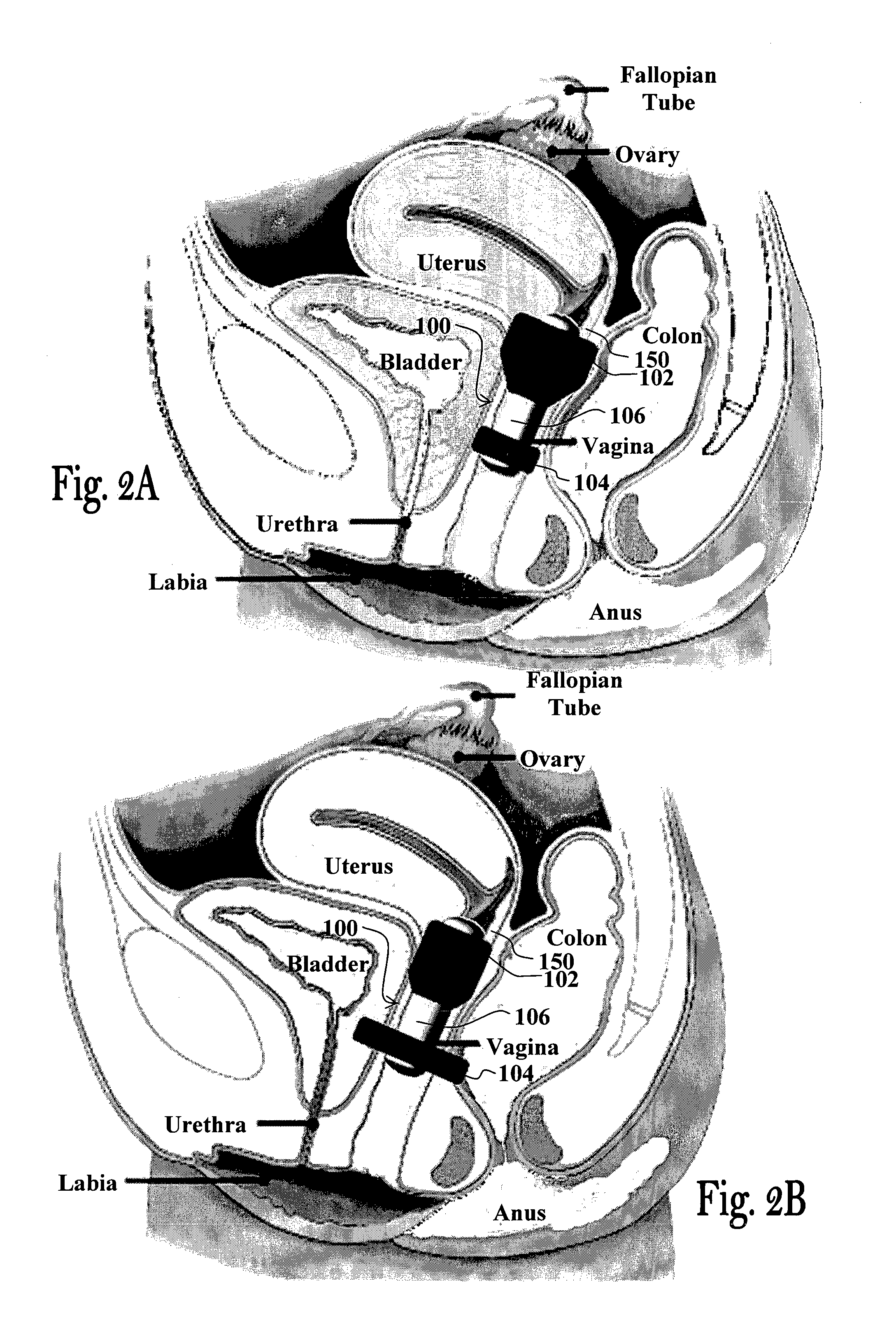 Female urinary incontinence device