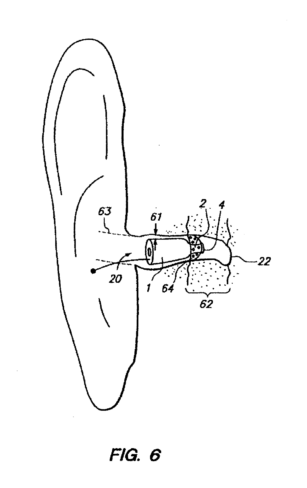 Open fit canal hearing device