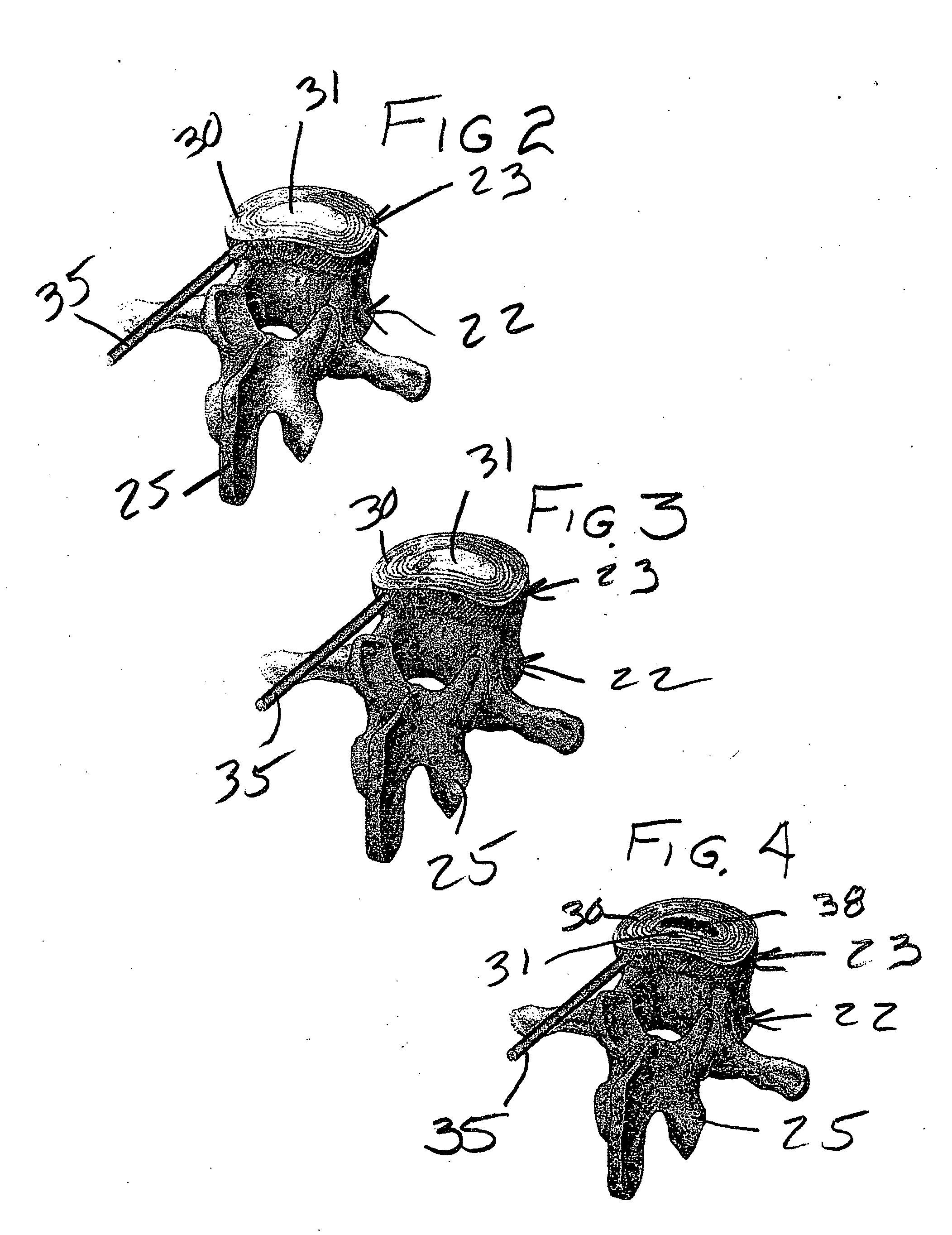 Method and composition for repair and reconstruction of intervertebral discs and other reconstructive surgery