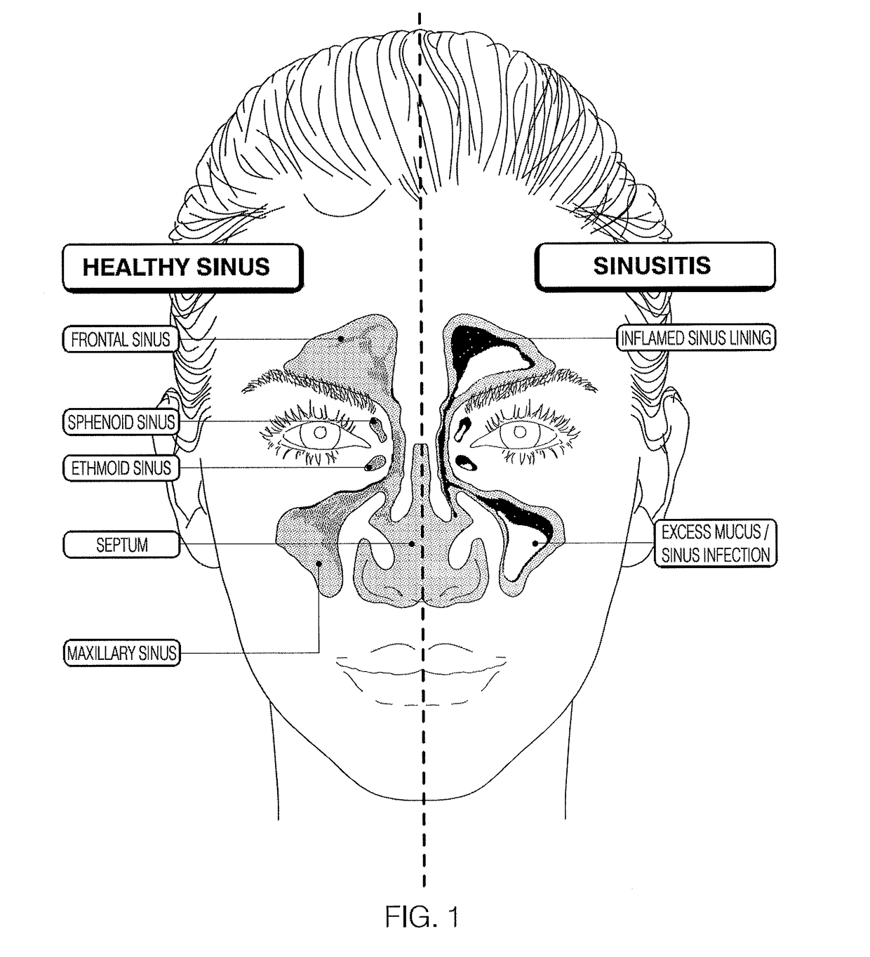 Devices and assays for diagnosis of sinusitis