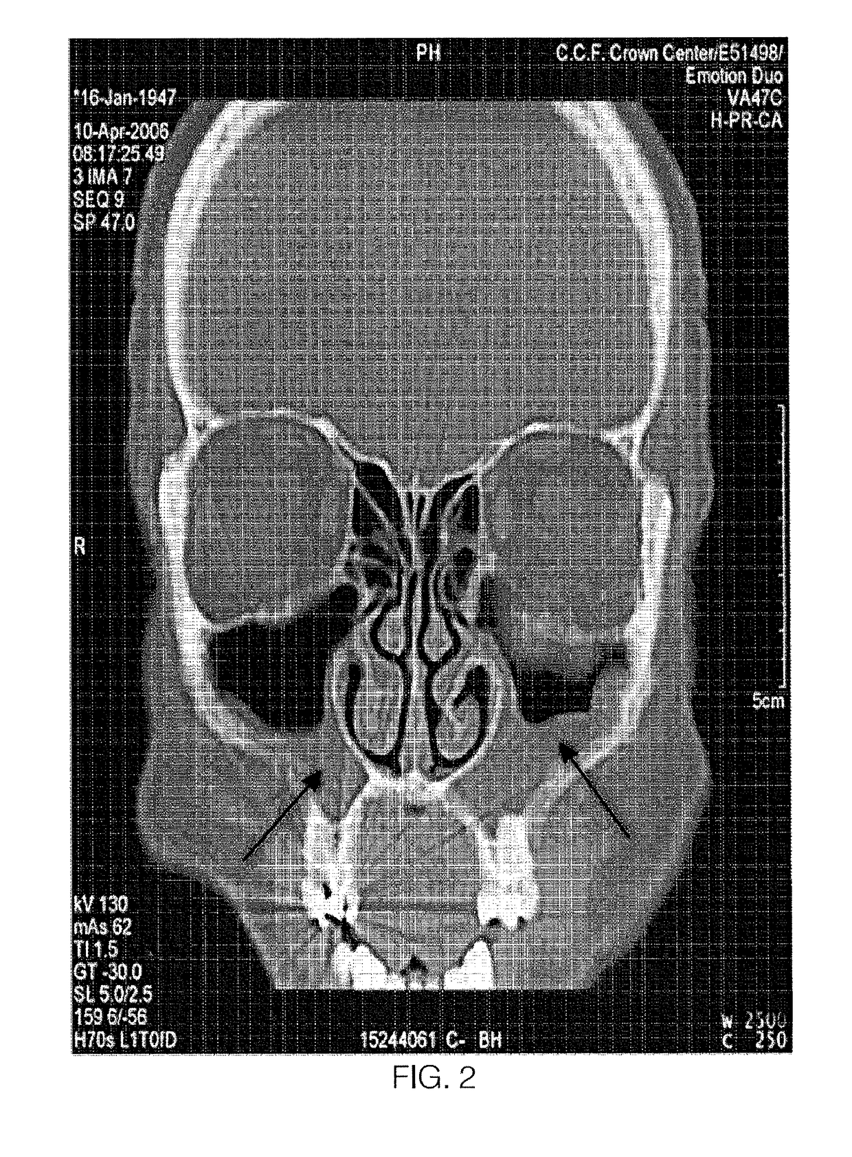 Devices and assays for diagnosis of sinusitis