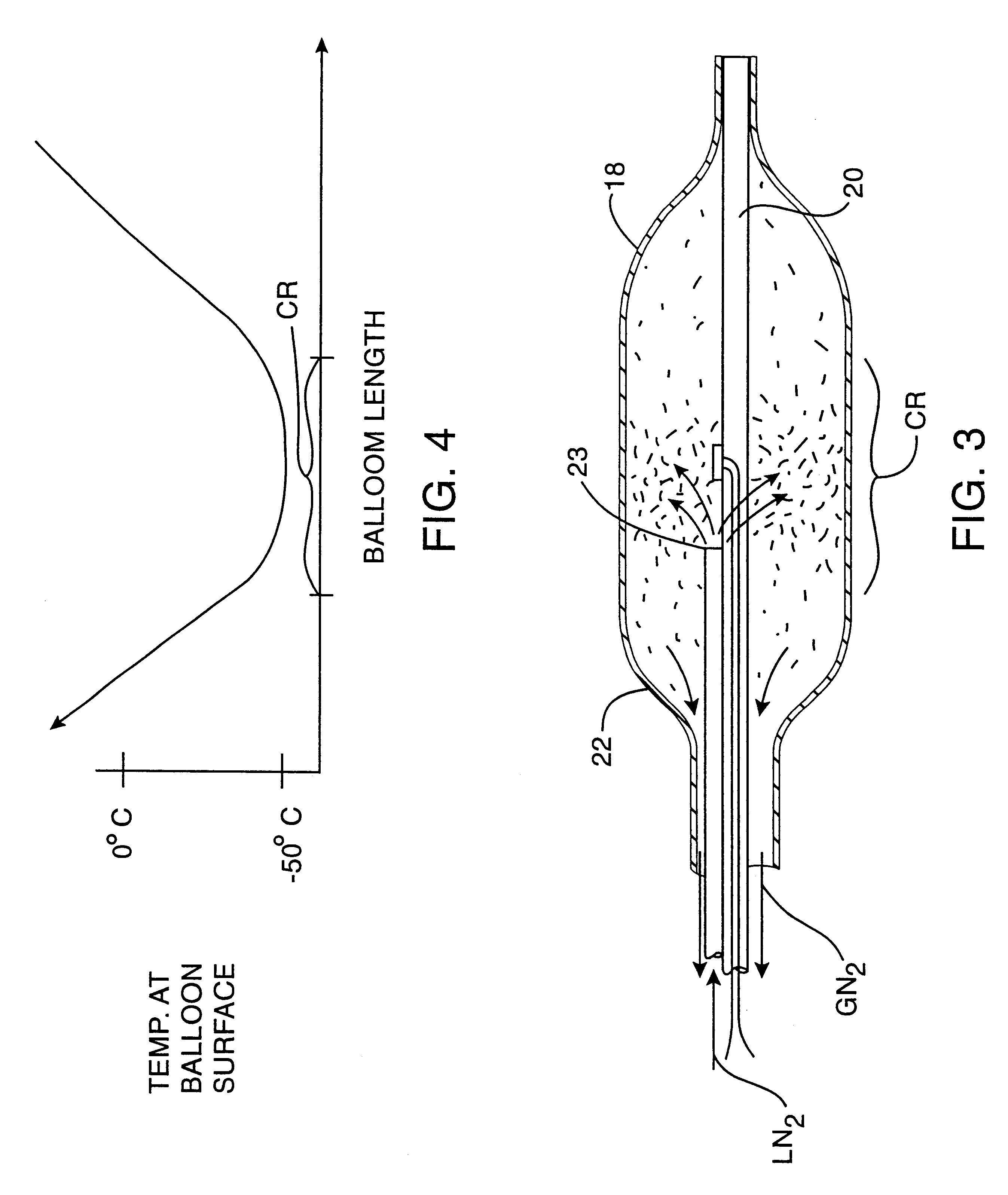 Apparatus and method for cryogenic inhibition of hyperplasia