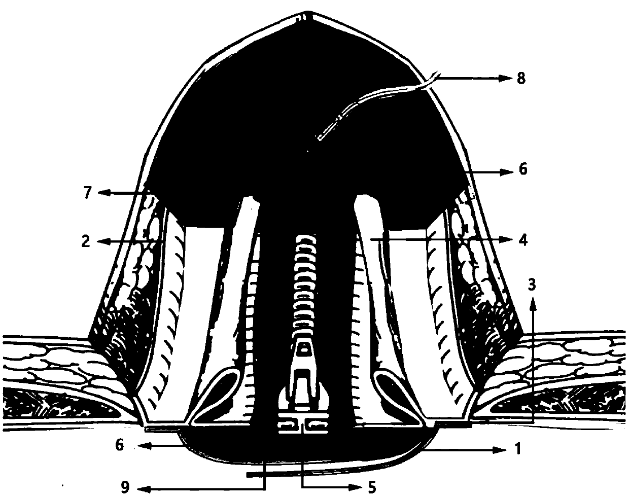 Temporary abdomen closing device