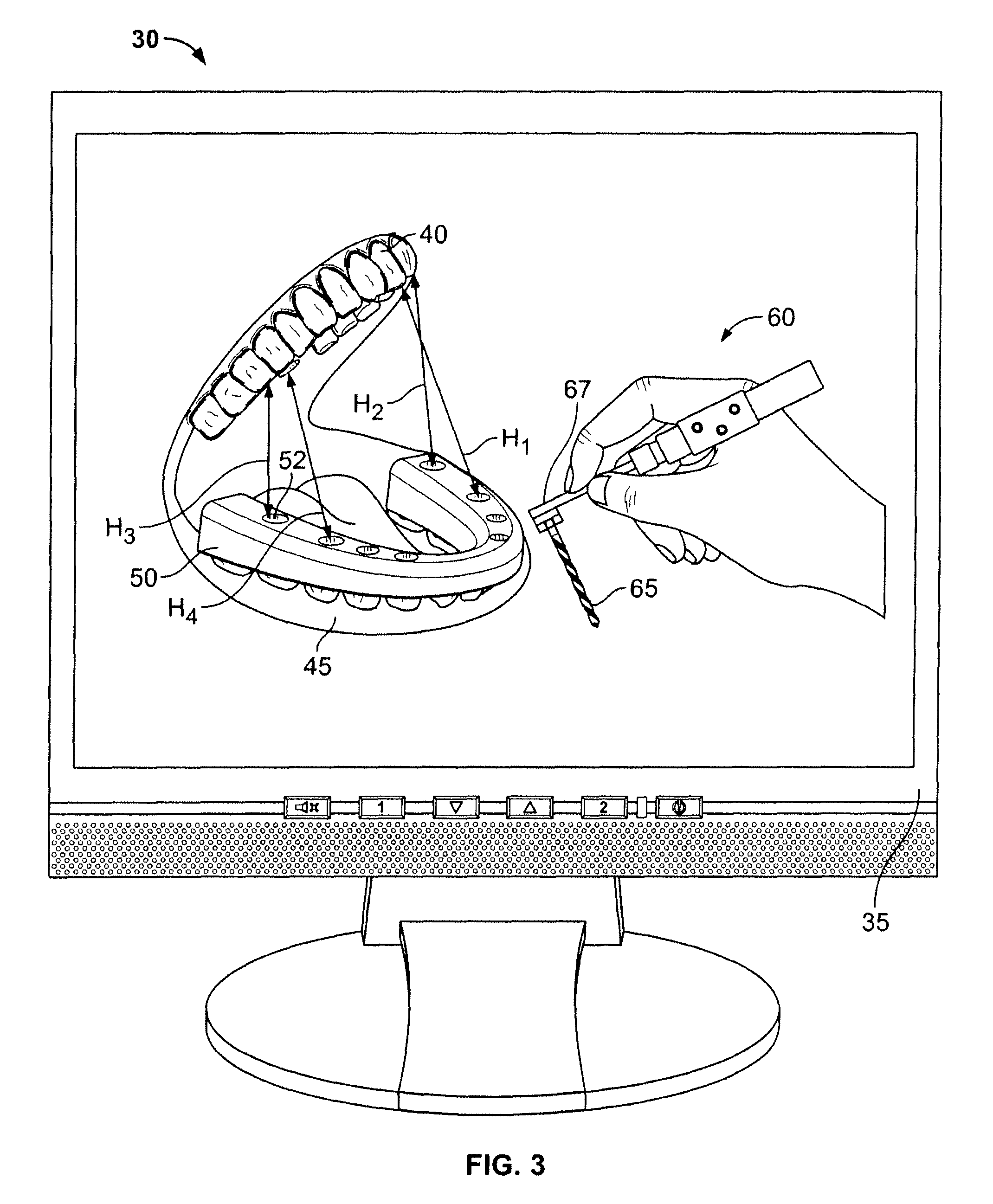 Method for pre-operative visualization of instrumentation used with a surgical guide for dental implant placement