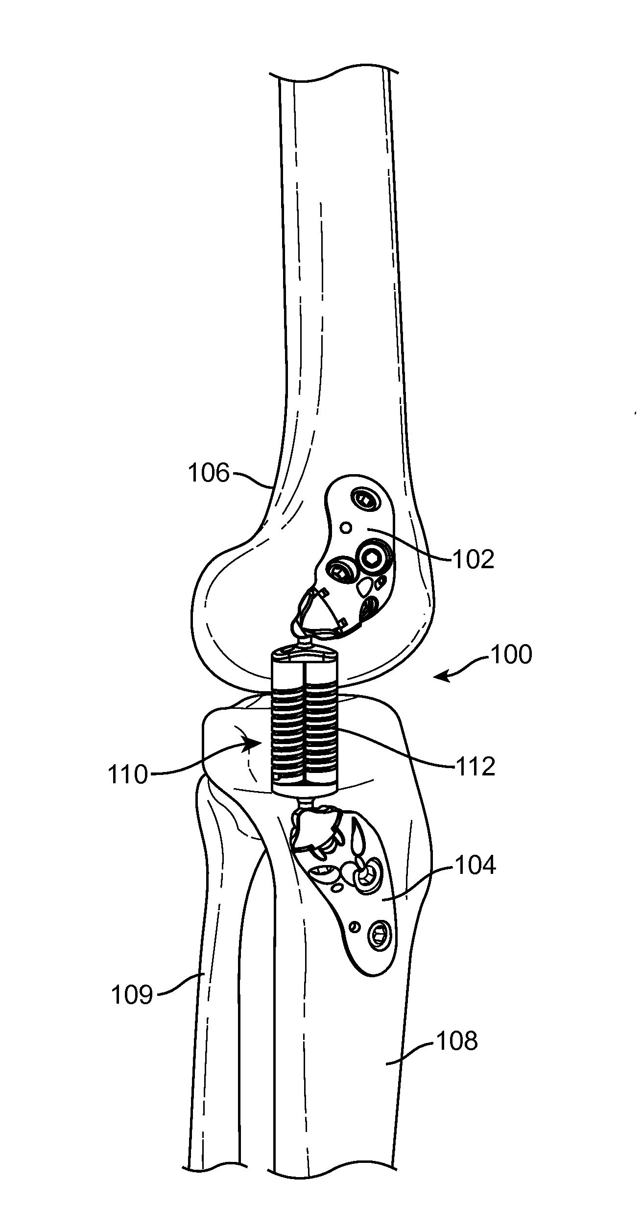 Methods and devices for joint load control during healing of joint tissue