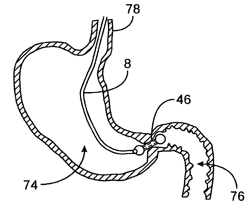 Pyloric valve corking device and method