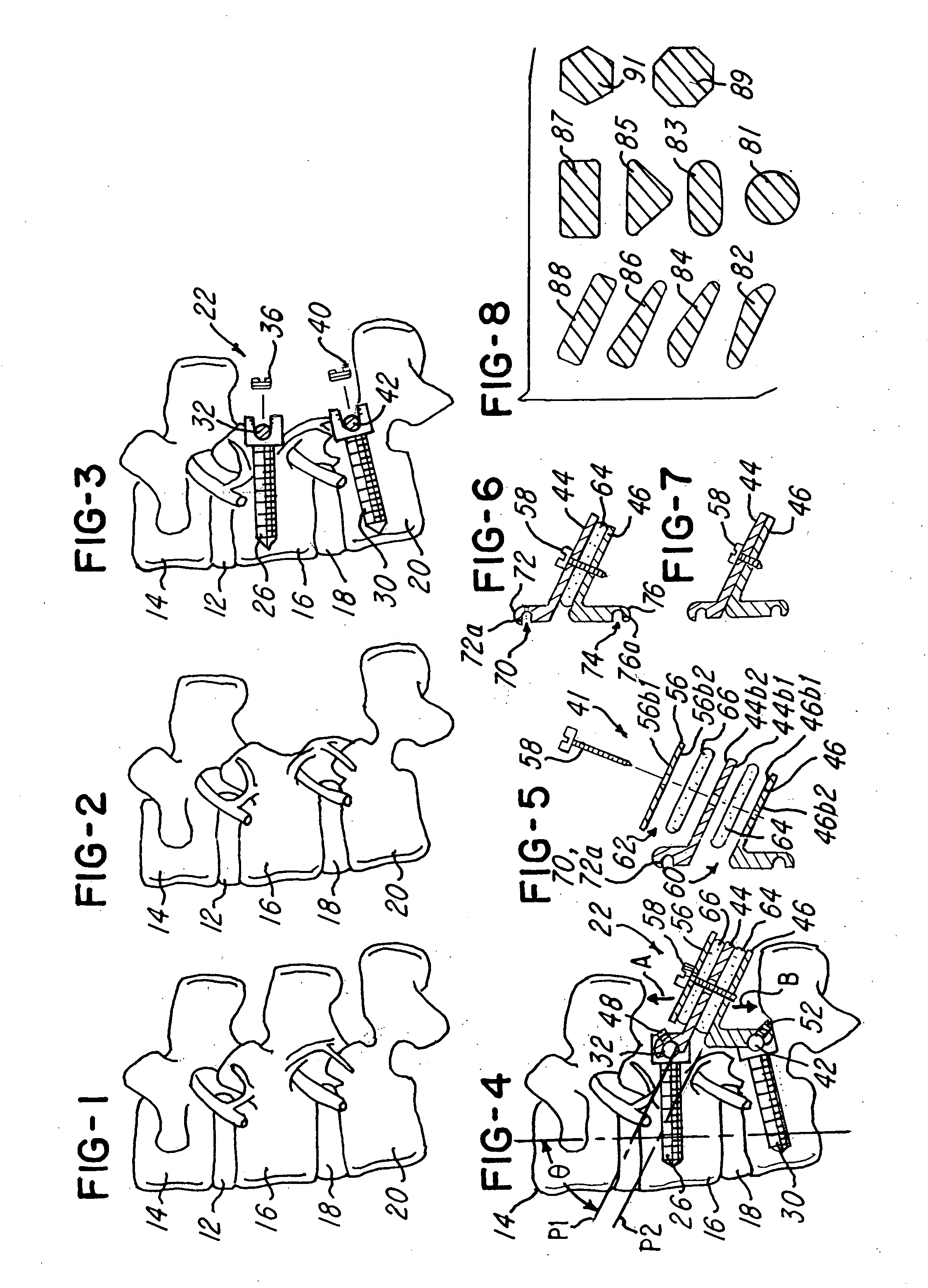 Disk augmentation system and method