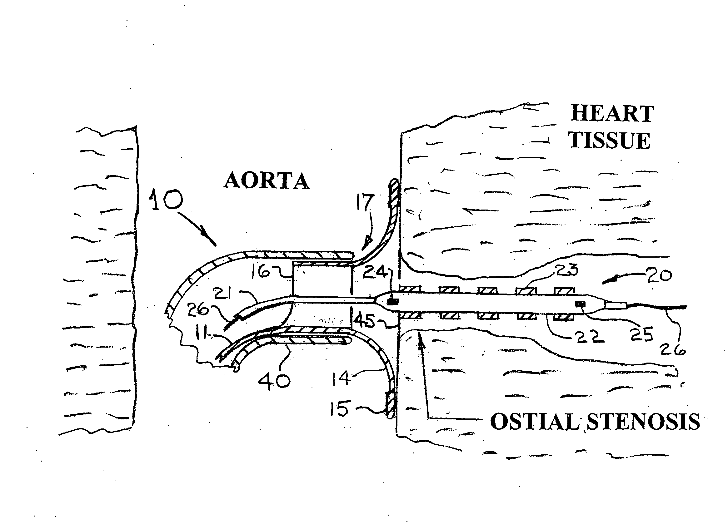 Introducer sheath for the placement of a stent at the ostium of an artery