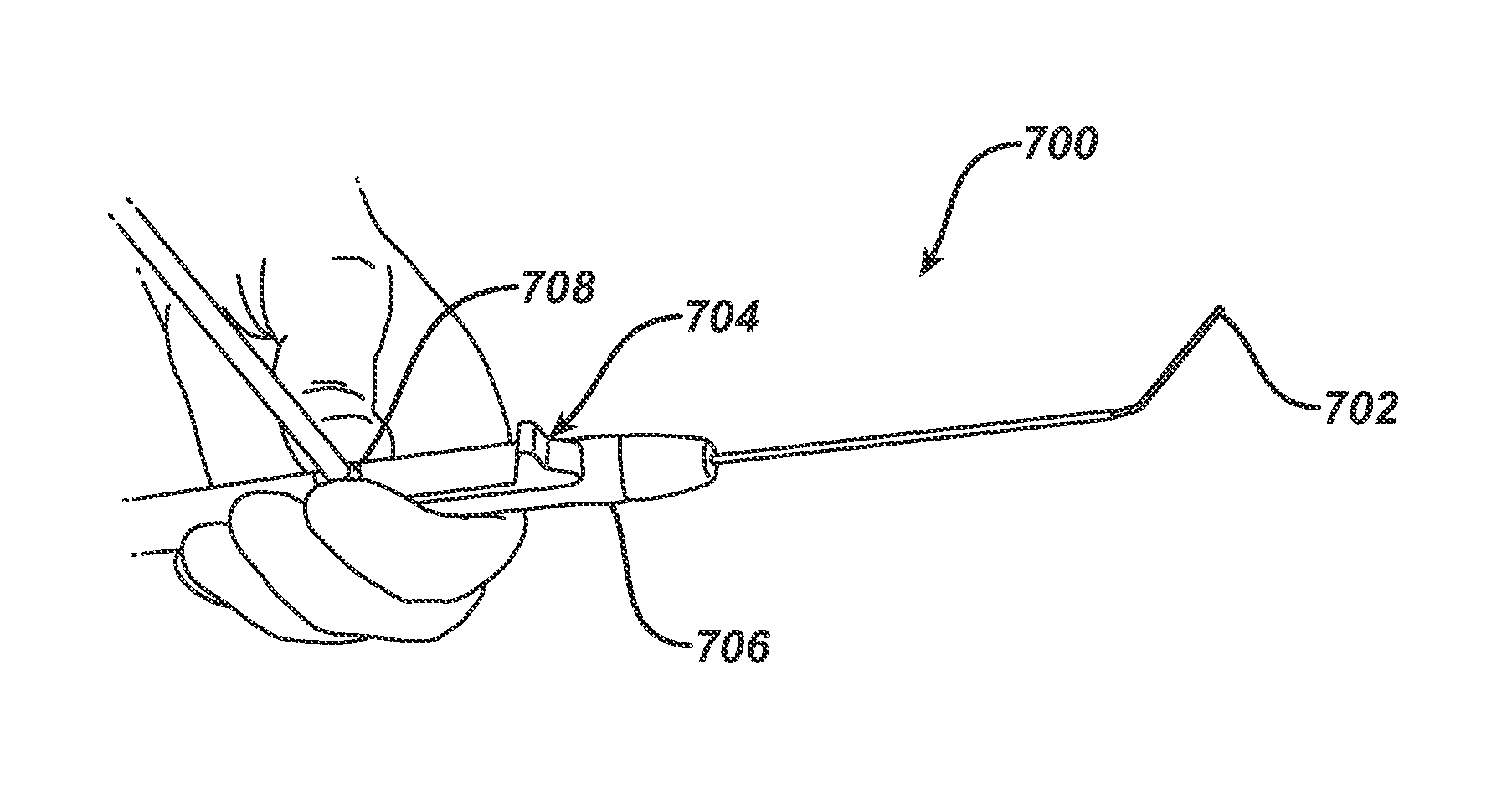 Devices and Method for Maxillary Sinus Lavage
