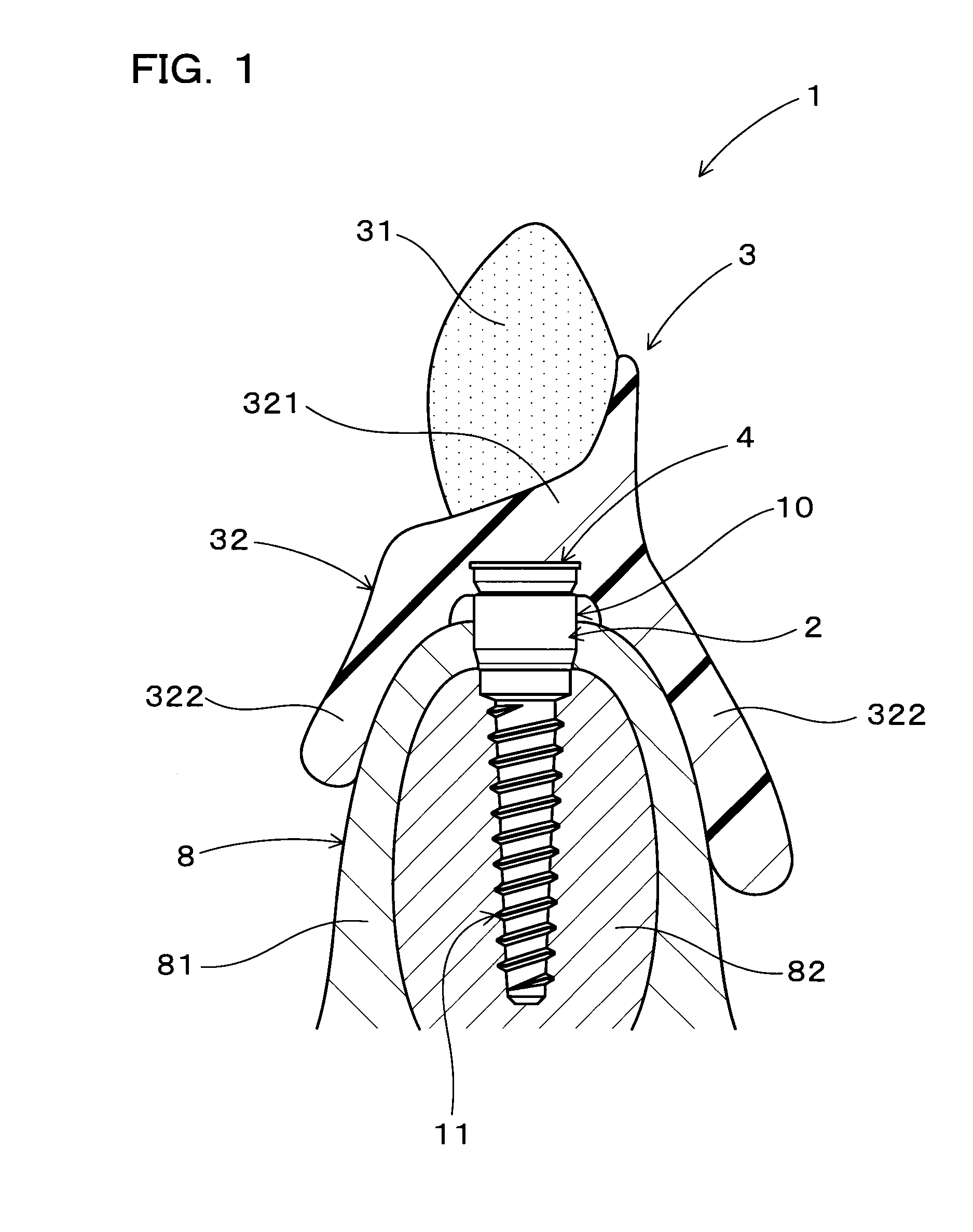 Implant overdenture system and implant