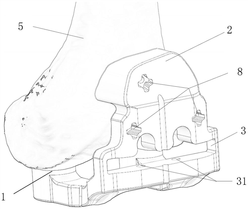 Knee joint osteotomy guide plate