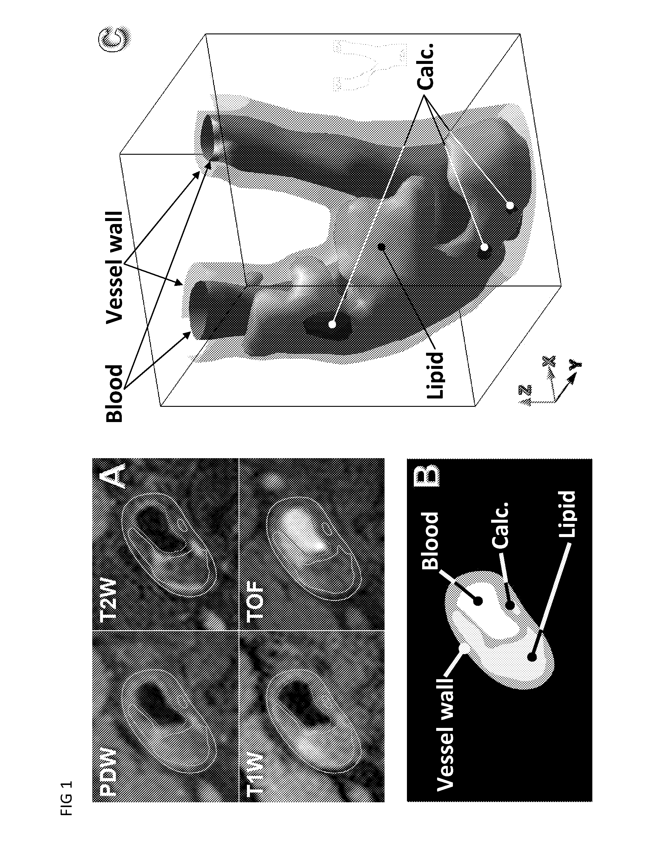 Method for calculating pressures in a fluid stream through a tube section, especially a blood vessel with atherosclerotic plaque