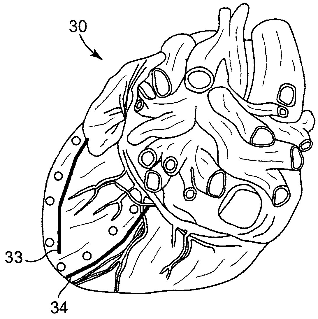 Intramyocardial patterning for global cardiac resizing and reshaping