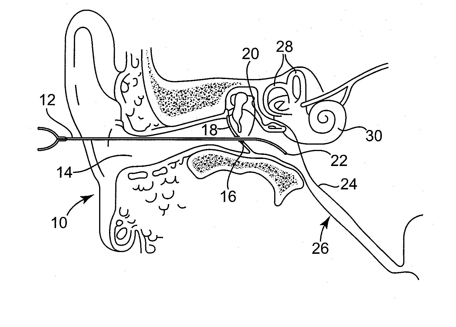 Solvating system and sealant for medical use in the middle or inner ear