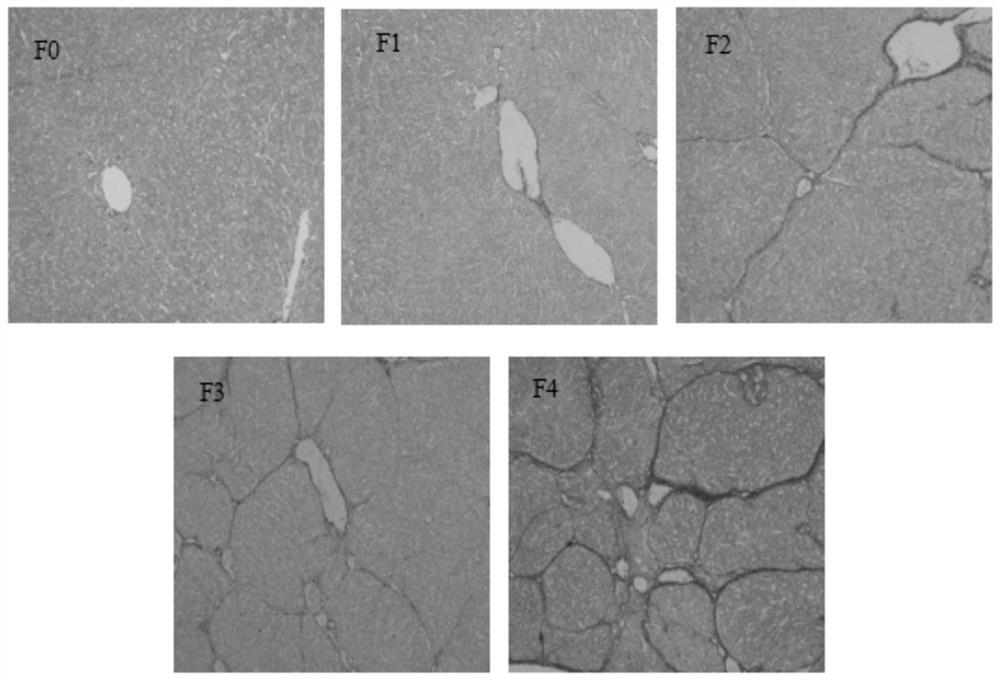 Method for obtaining liver phosphorus spectrum based on 31P-MRS and liver ATP metabolism index