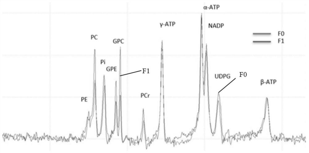 Method for obtaining liver phosphorus spectrum based on 31P-MRS and liver ATP metabolism index