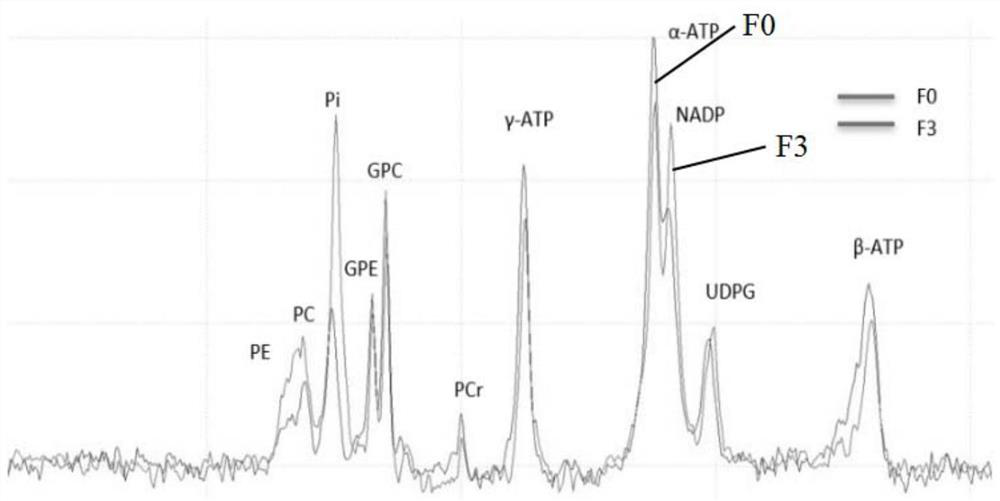 Method for obtaining liver phosphorus spectrum based on 31P-MRS and liver ATP metabolism index