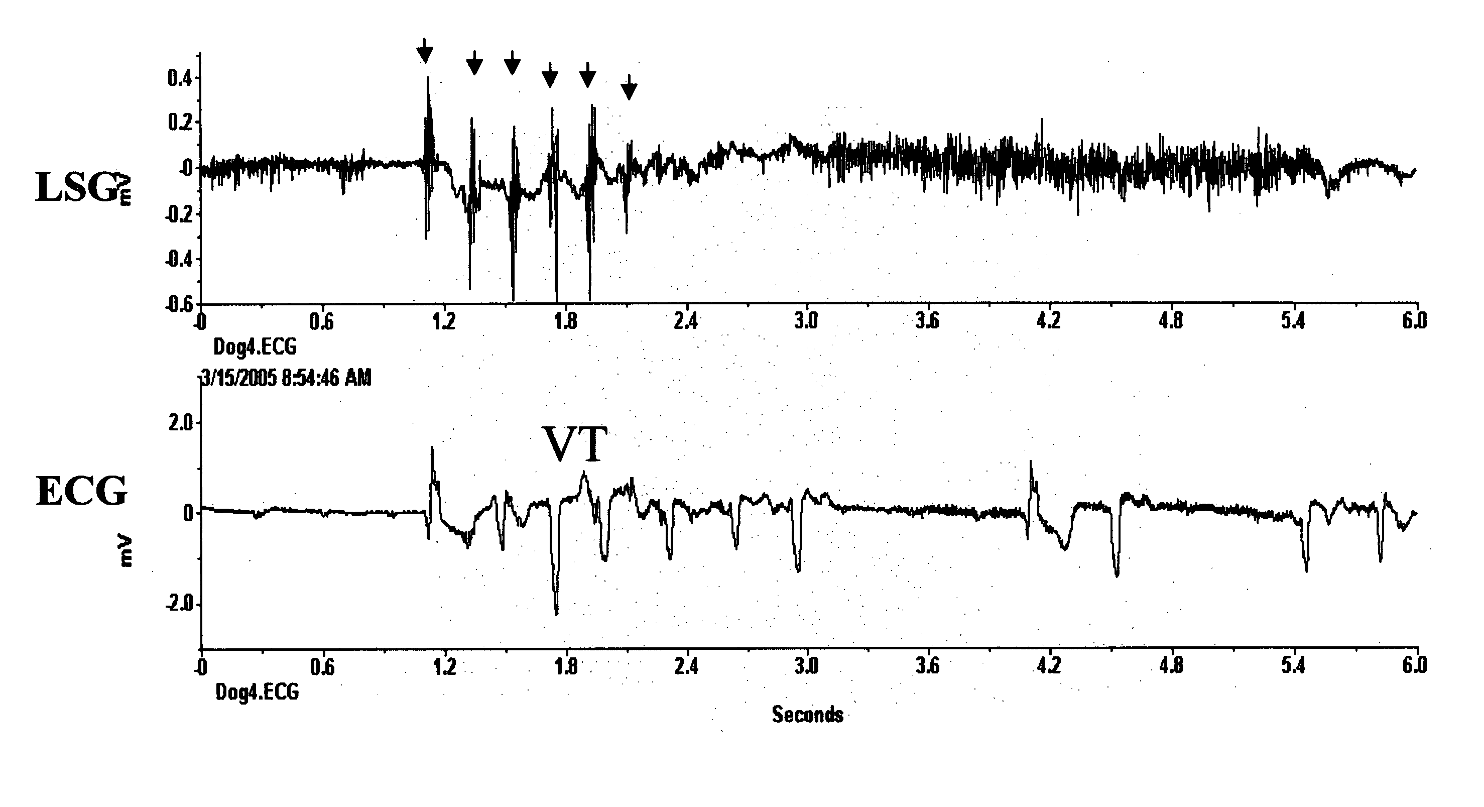 Method and system for the prediction of cardiac arrhythmias, myocardial ischemia, and other diseased condition of the heart associated with elevated sympathetic neural discharges