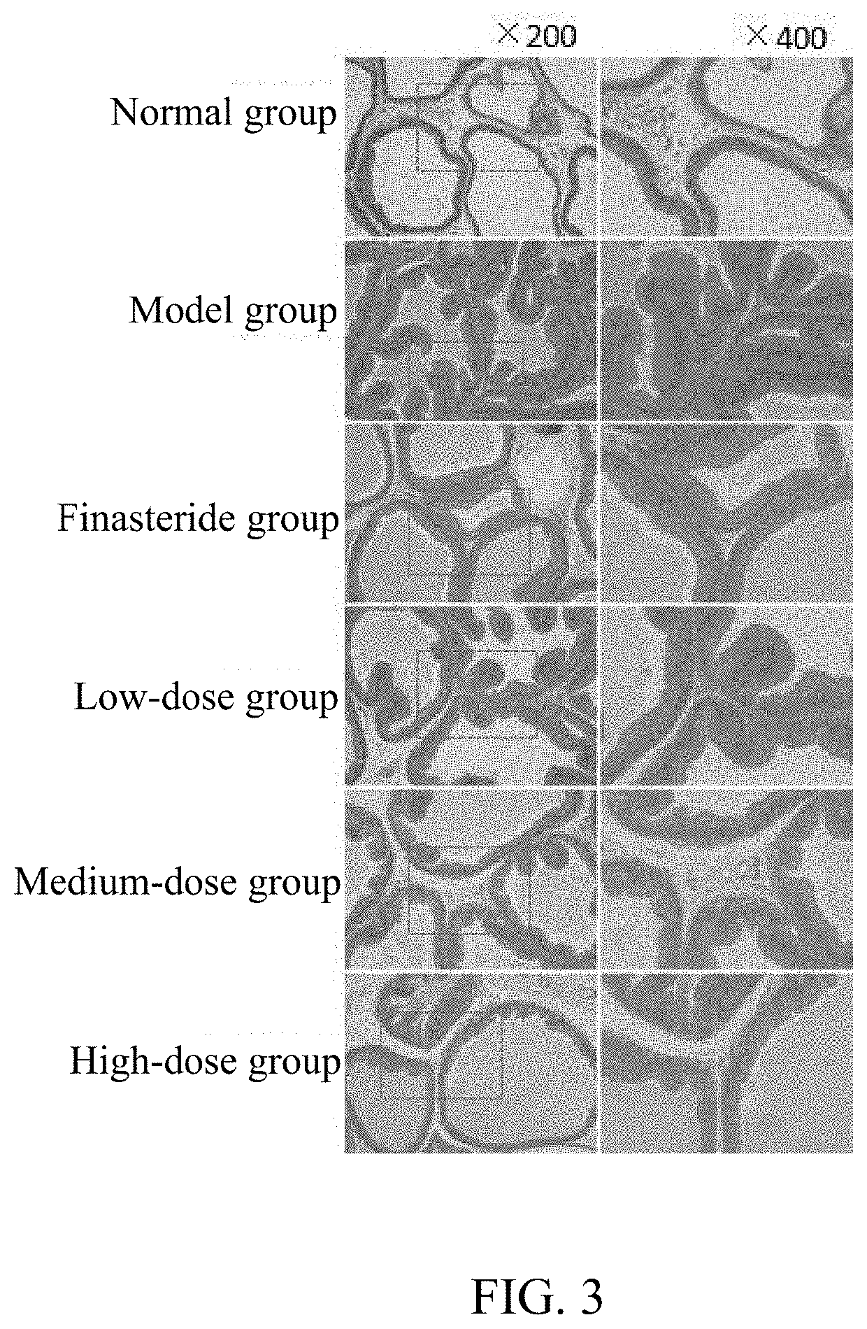 Sterol composition in pumpkin seed oil and application thereof, and drug for treating benign prostatic hyperplasia