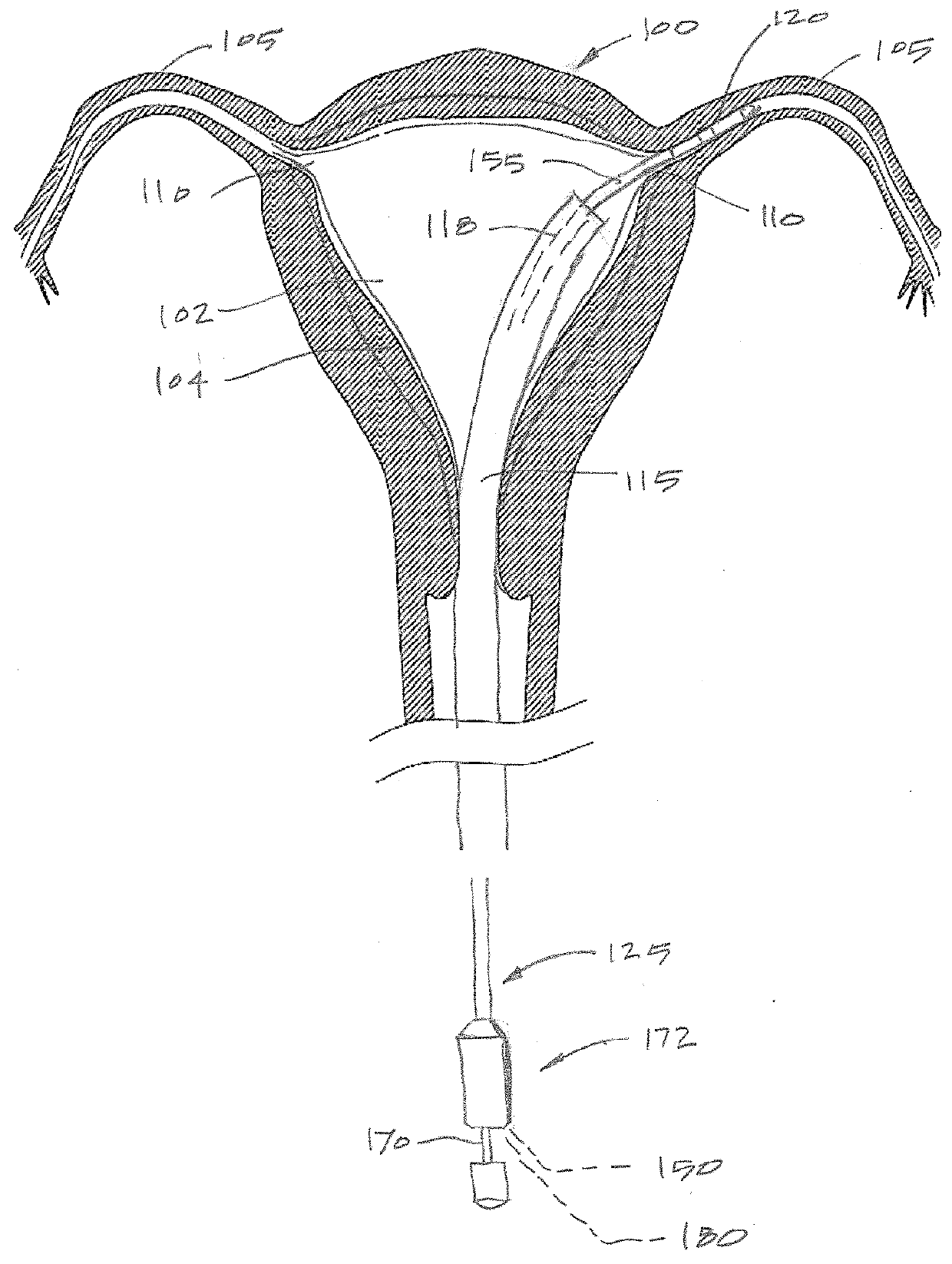 Systems and methods for female contraception