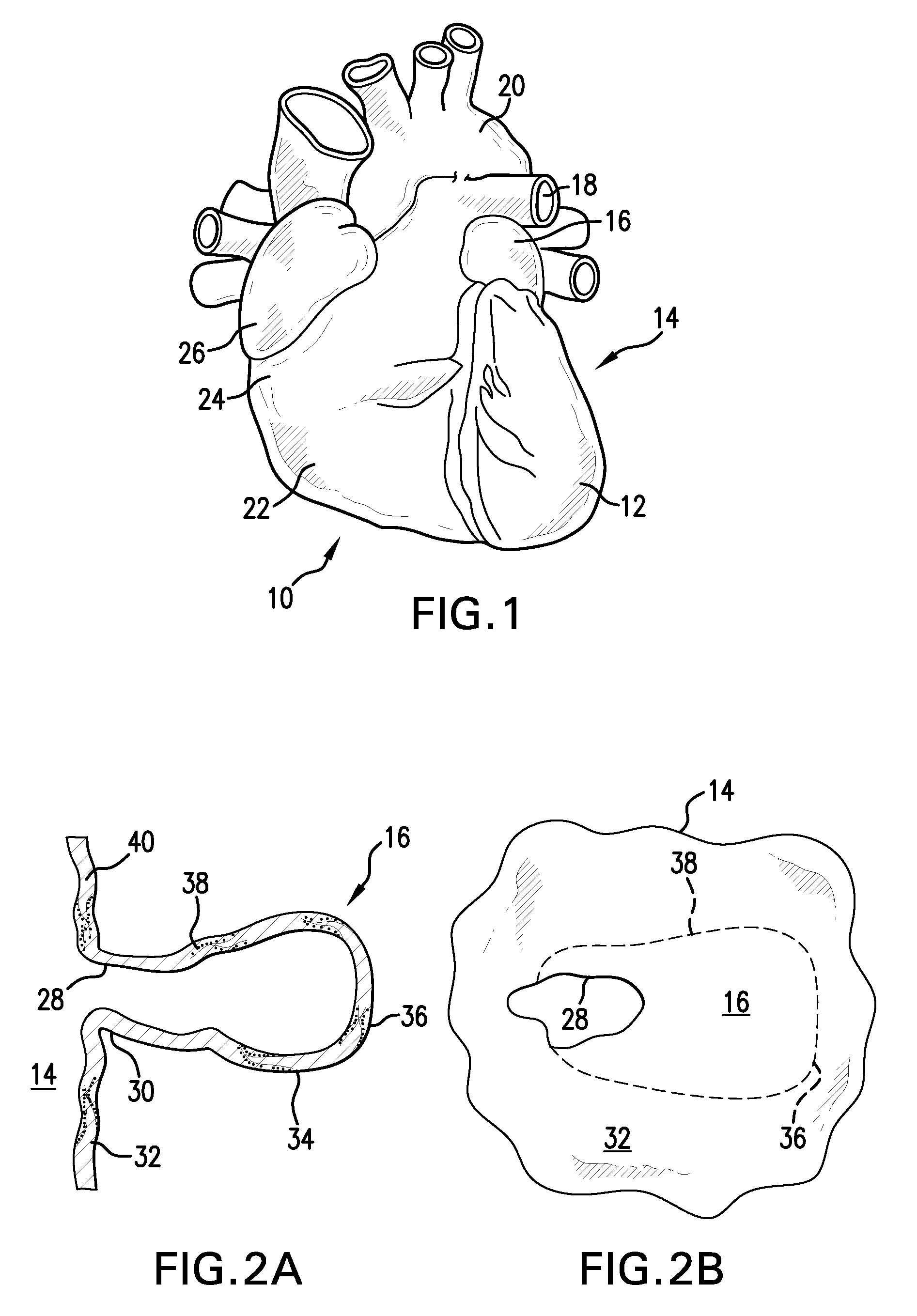 Apparatus And Methods For Excluding The Left Atrial Appendage