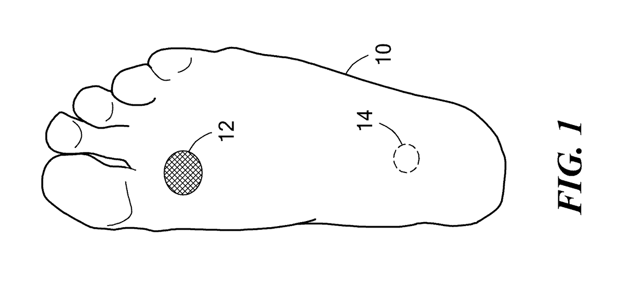 Footwear System for Ulcer or Pre-Ulcer Detection