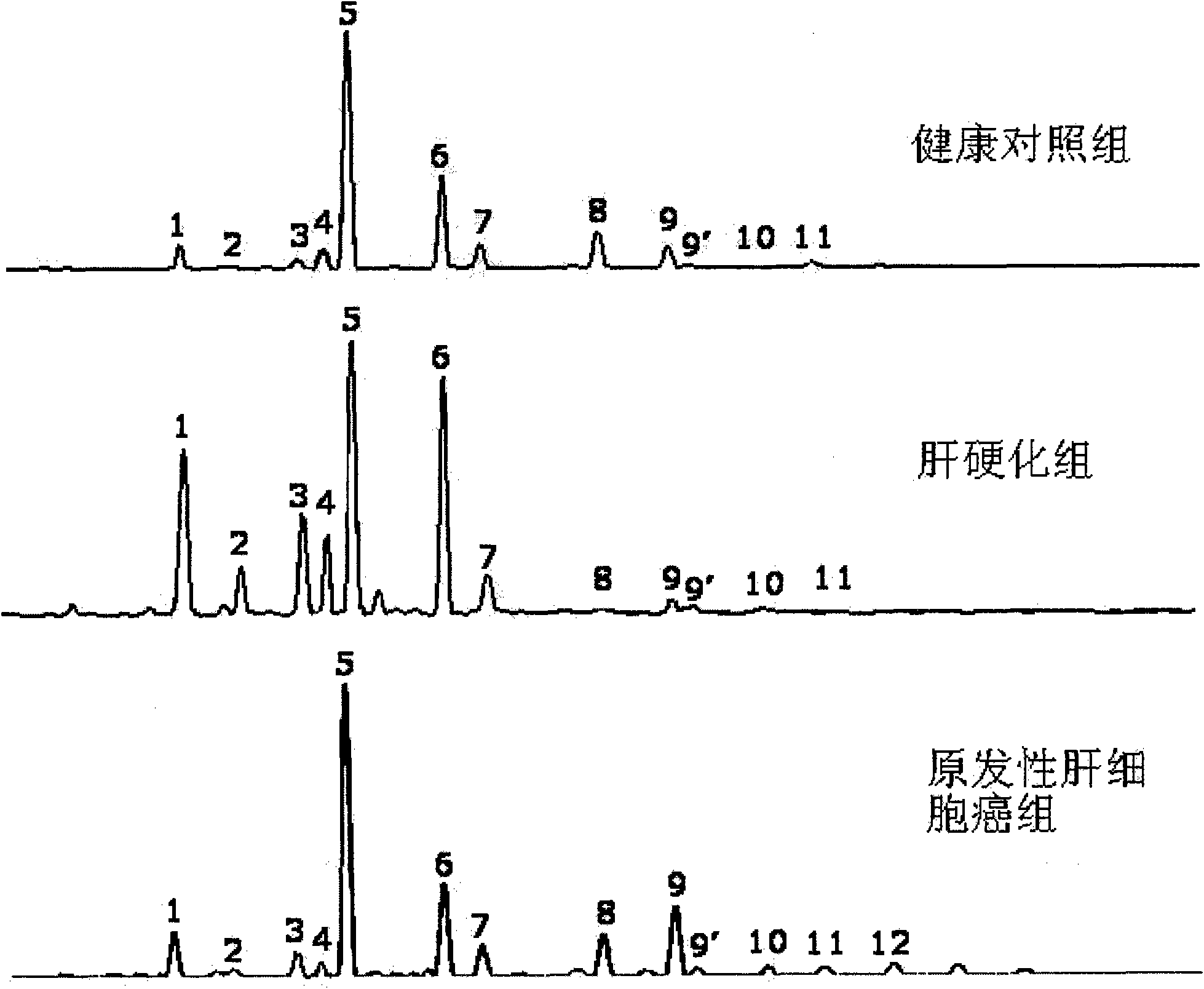 Method for detecting N-glycome log (P9/P4) in serum and detecting system and application thereof