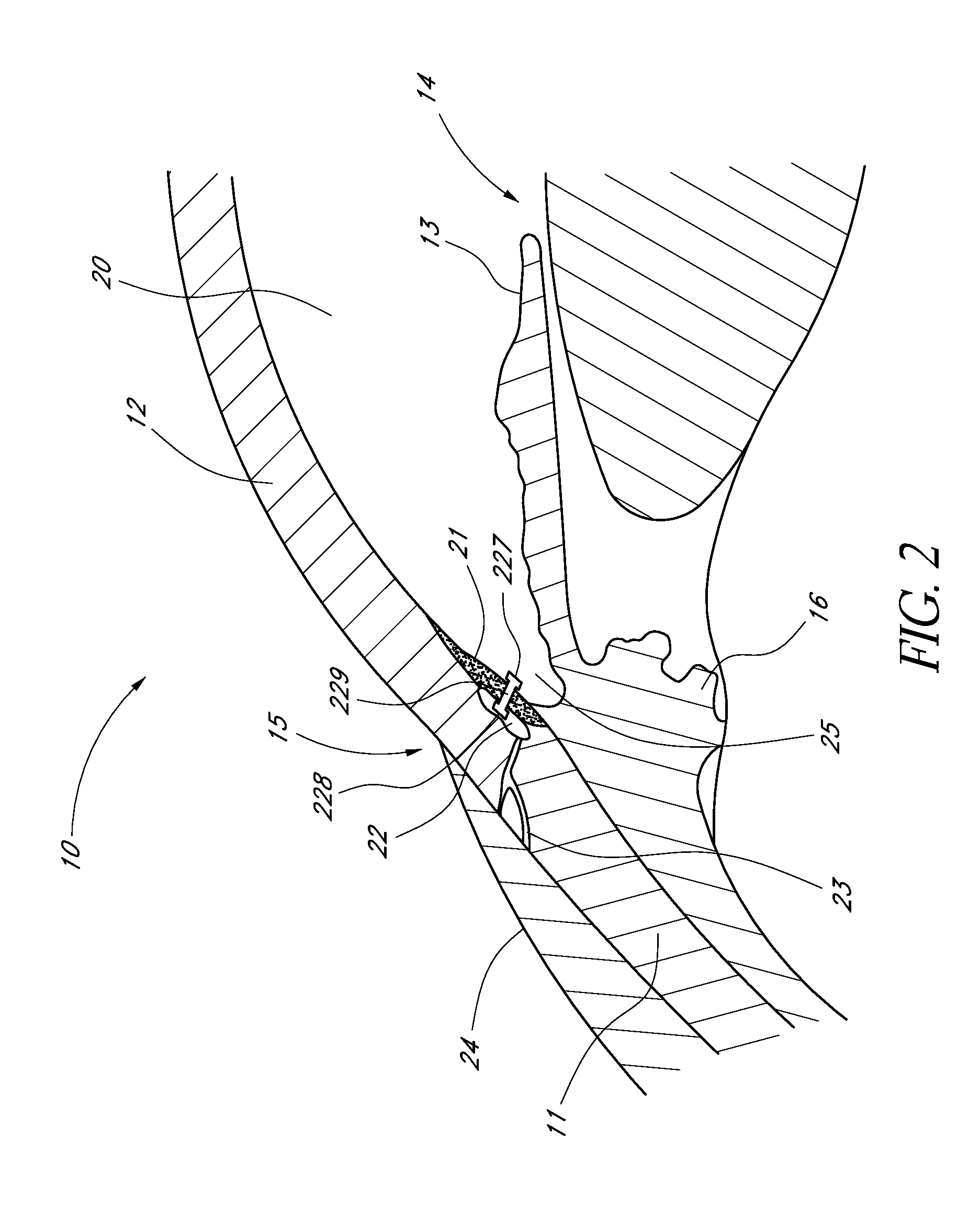 Ocular implants with anchors and methods thereof