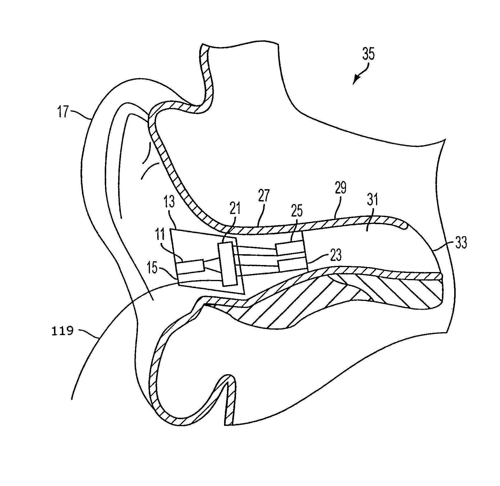 Earhealth monitoring system and method II