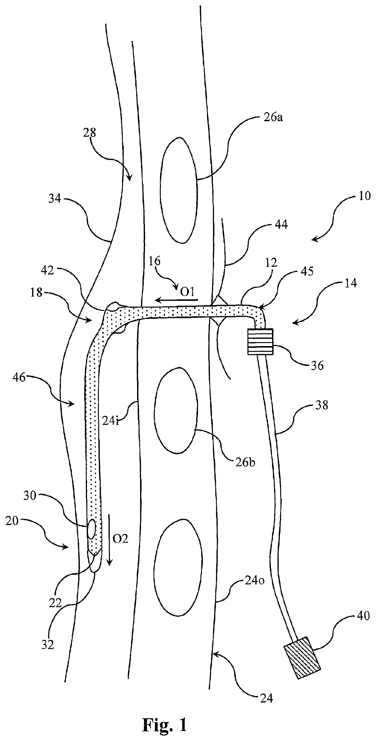 Needle assembly for relieving a pneumothorax