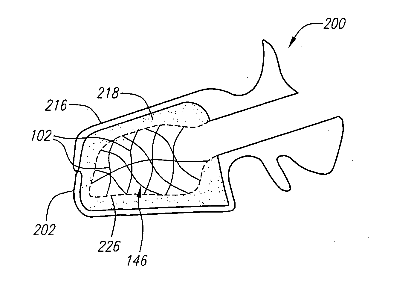 Biocompatible wires and methods of using same to fill bone void