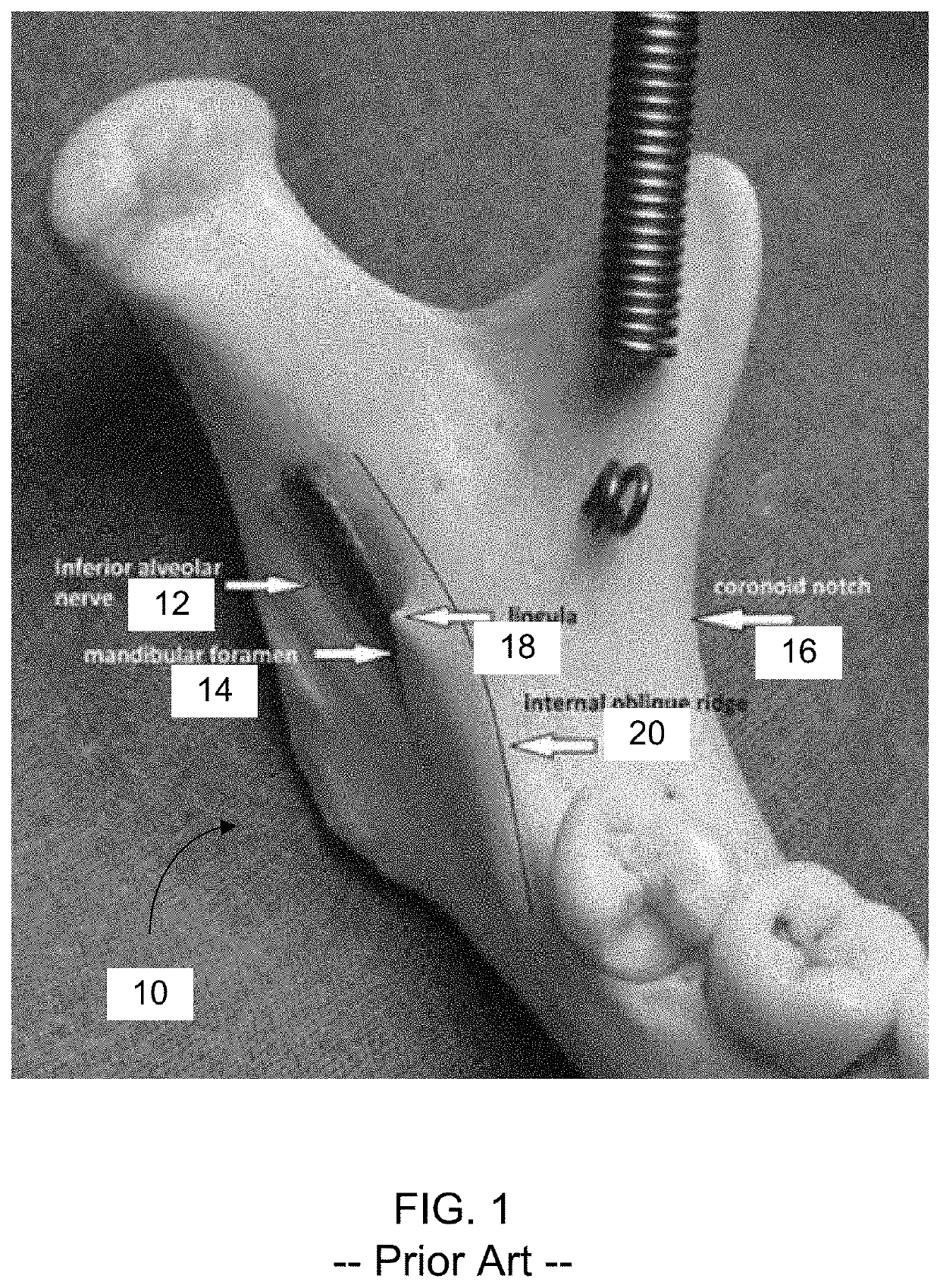 Mandibular Anesthesia Curved Dental Needle