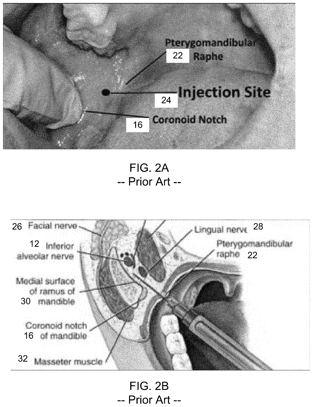 Mandibular Anesthesia Curved Dental Needle