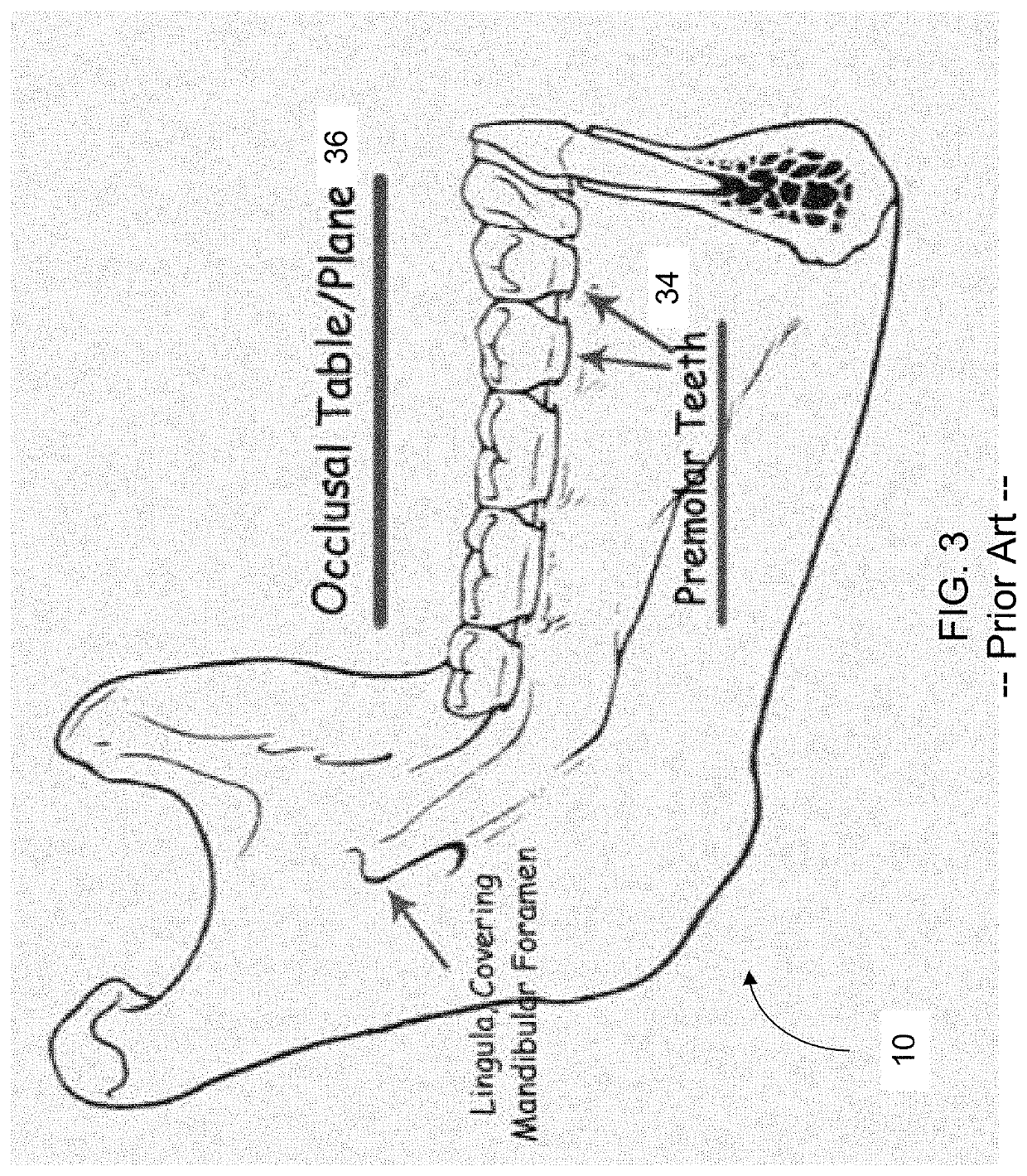 Mandibular Anesthesia Curved Dental Needle