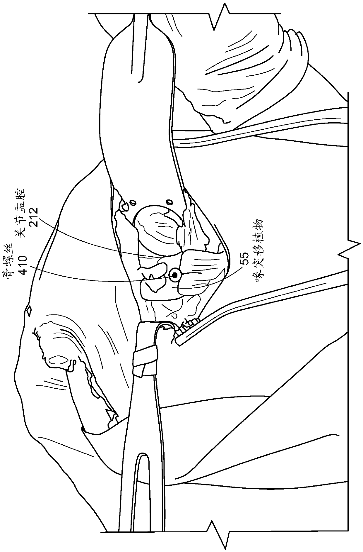 Open LATARJET for correction of anterior-inferior glenoid bone loss