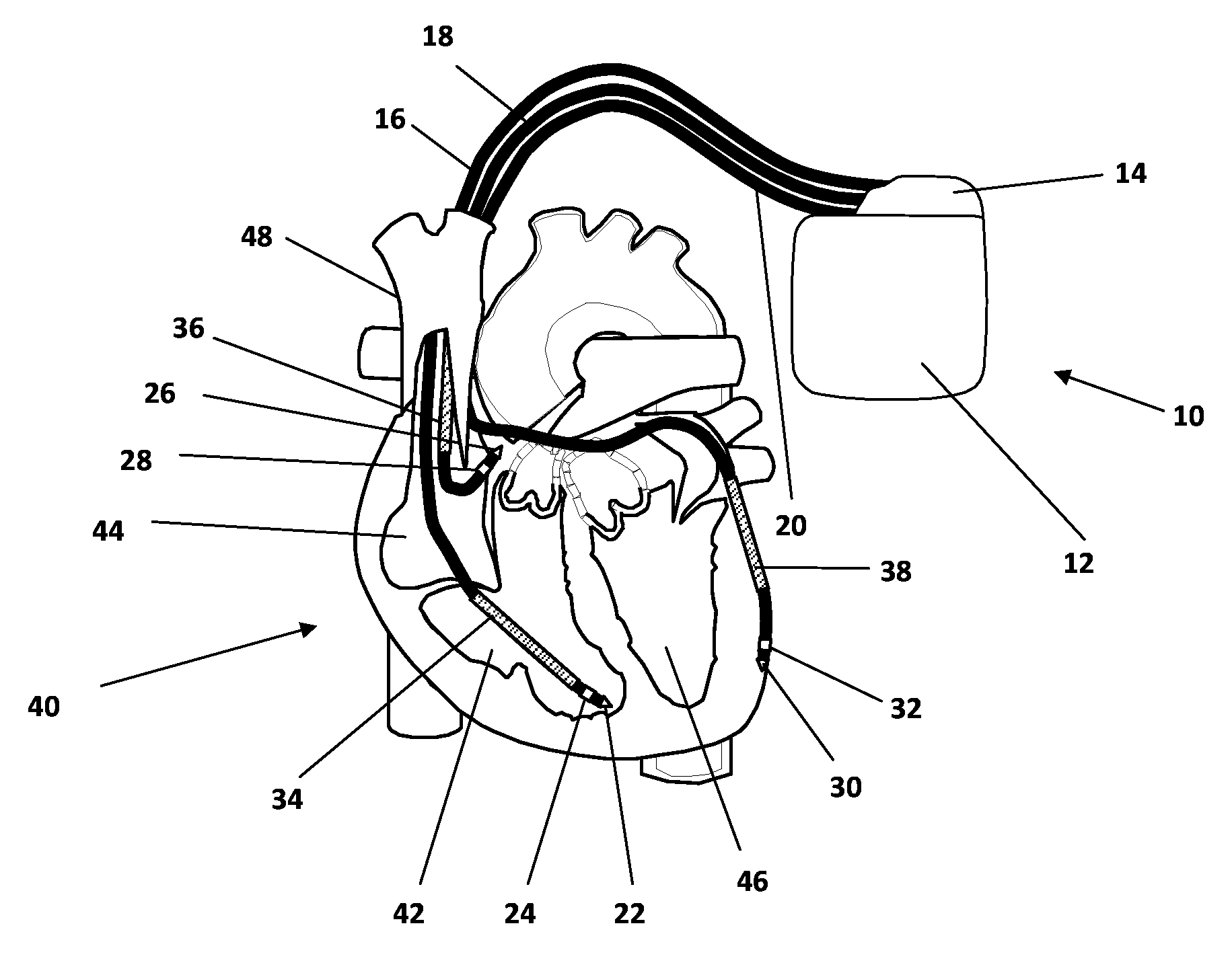 Implantable heart stimulator and method for trending analysis of ventricular activation time