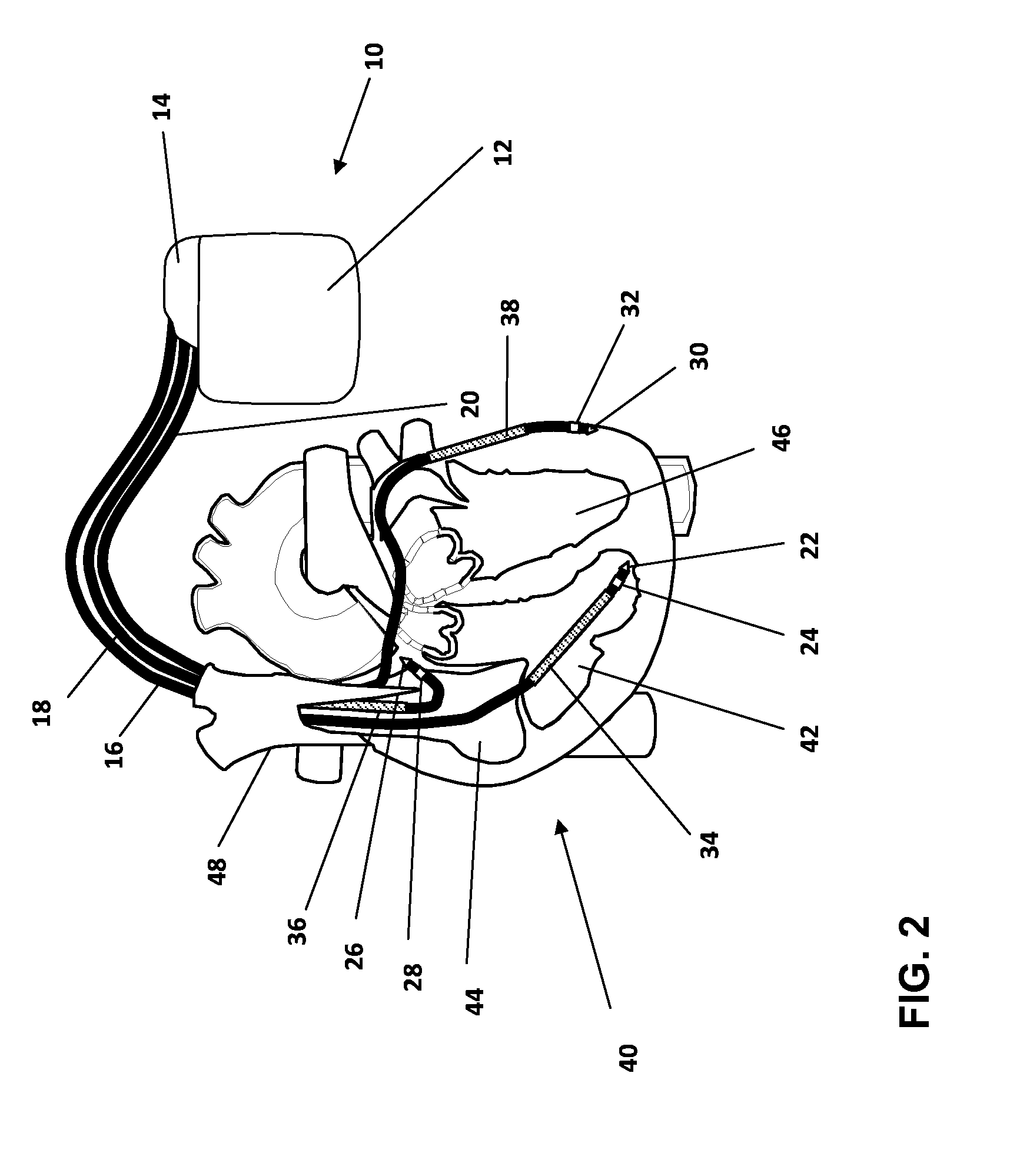 Implantable heart stimulator and method for trending analysis of ventricular activation time