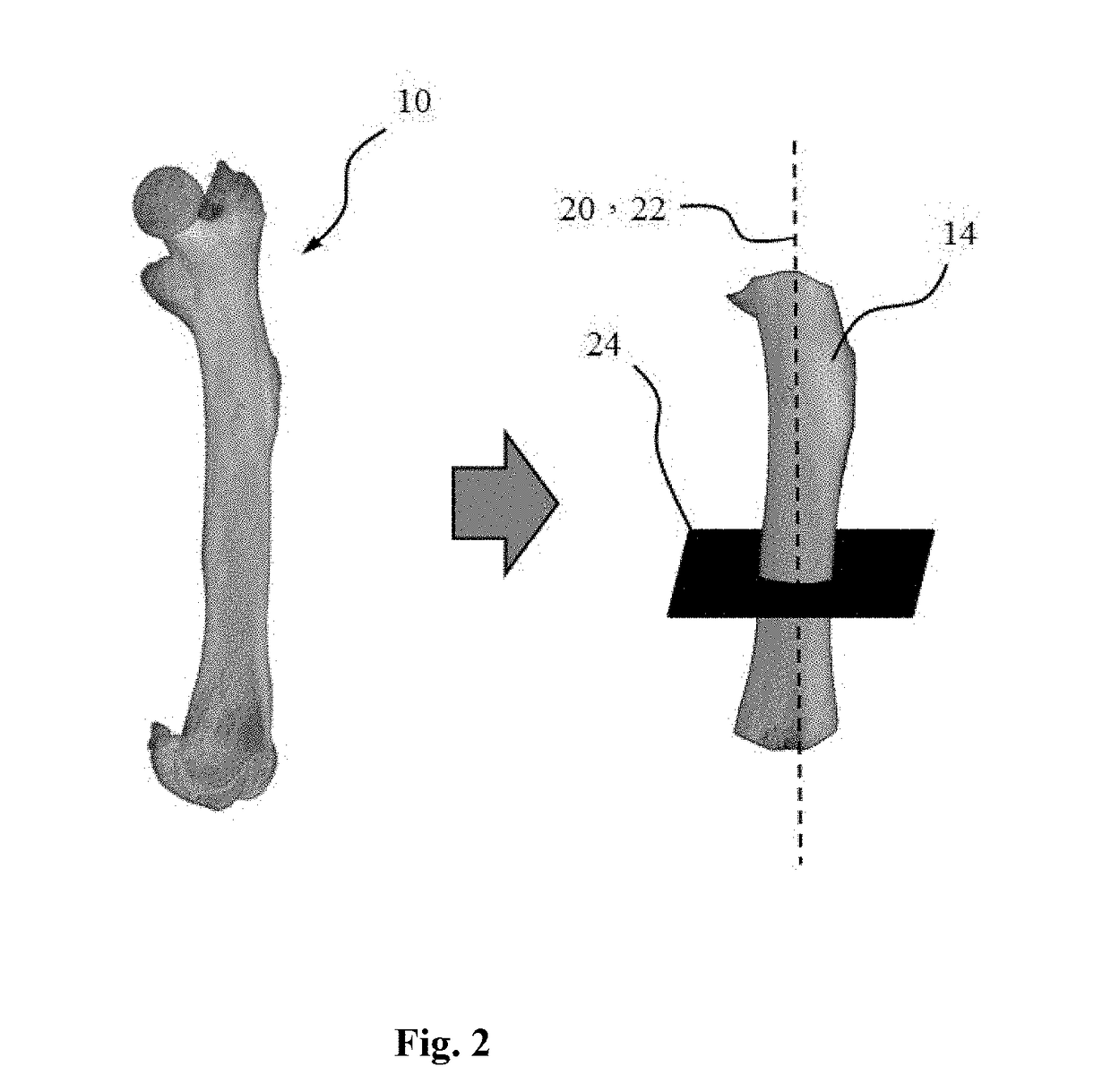 Method and system for detection of bone structure