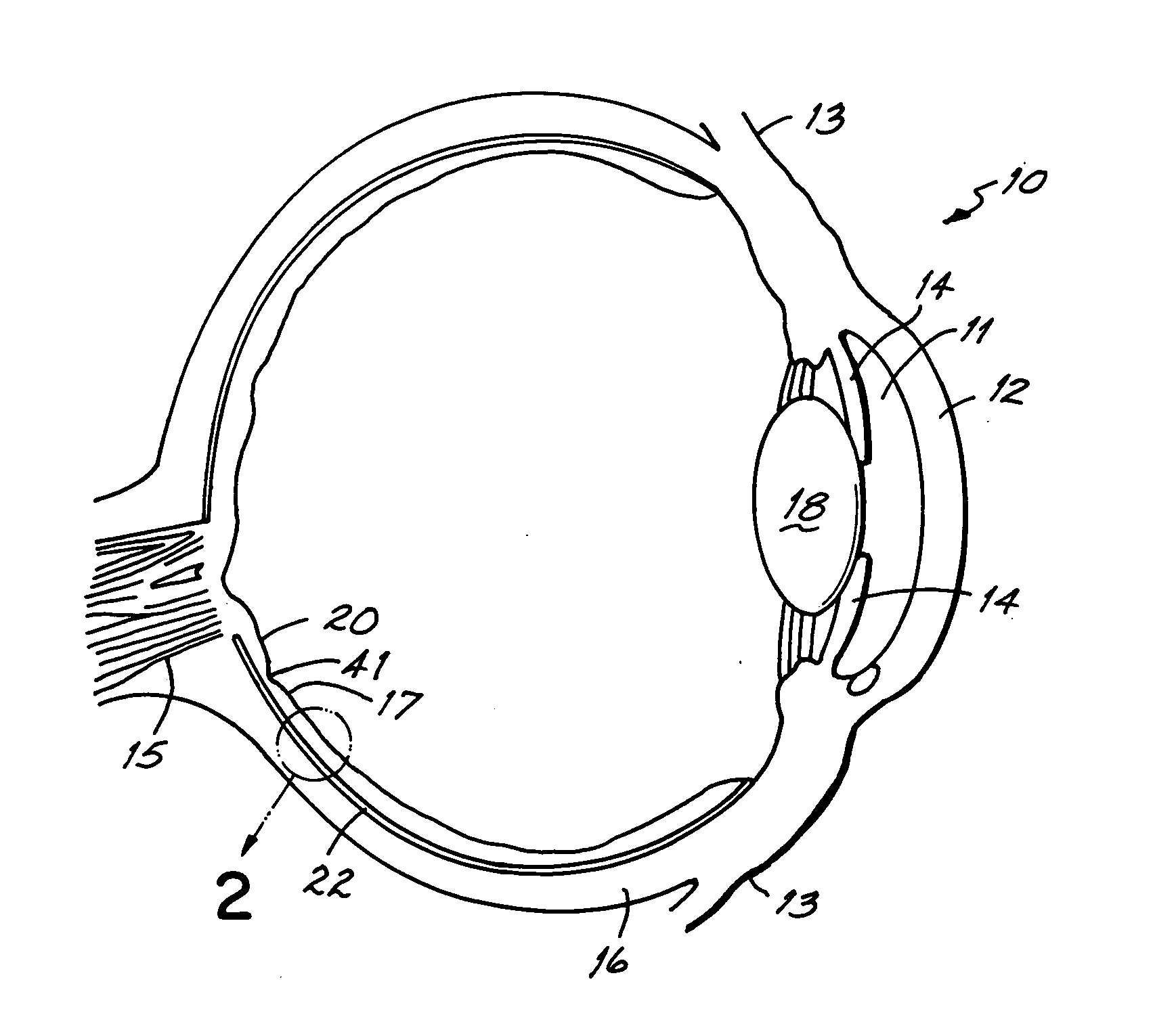 Method to treat age-related macular degeneration