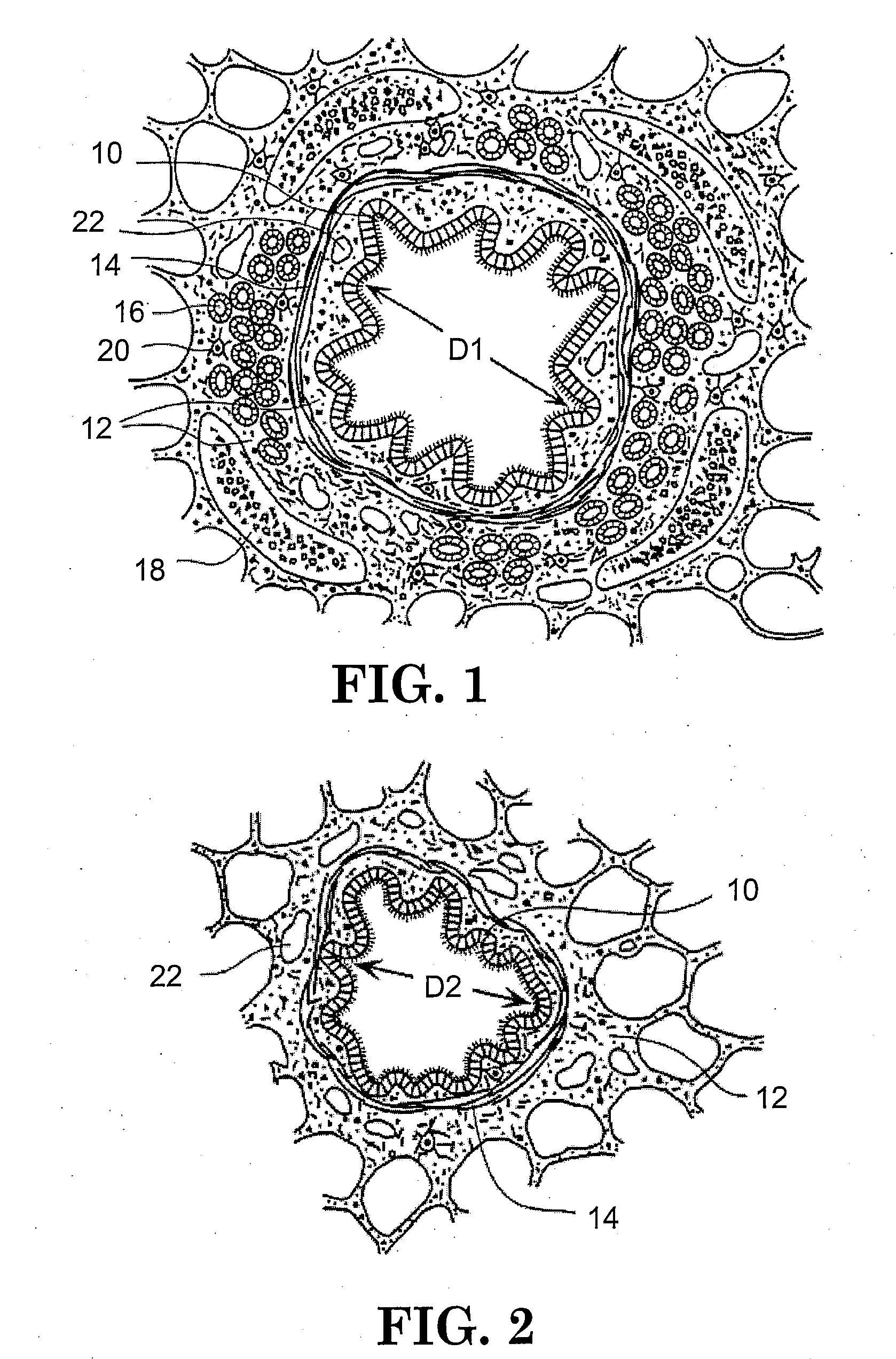 Method for treating airways in the lung