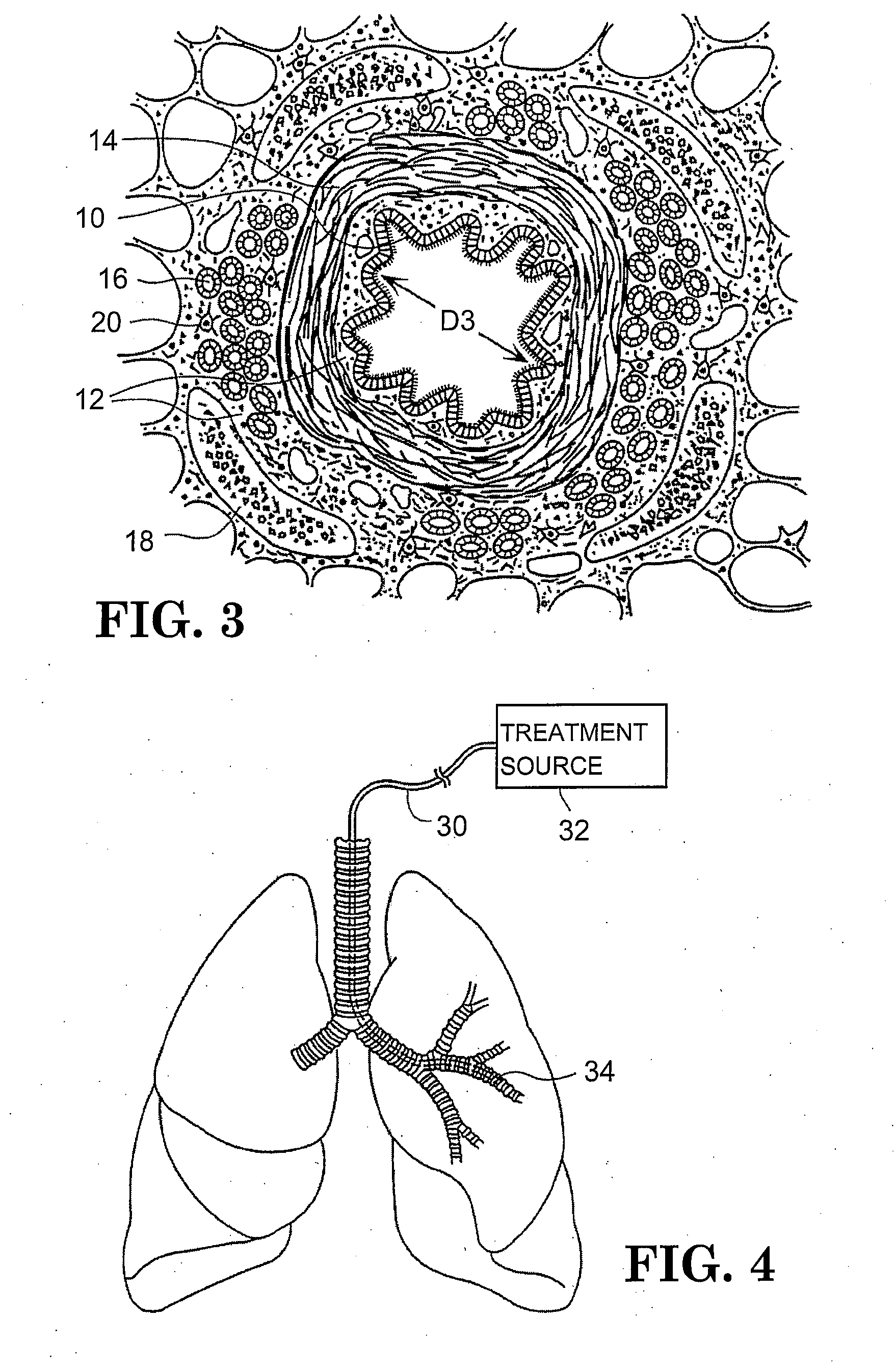 Method for treating airways in the lung
