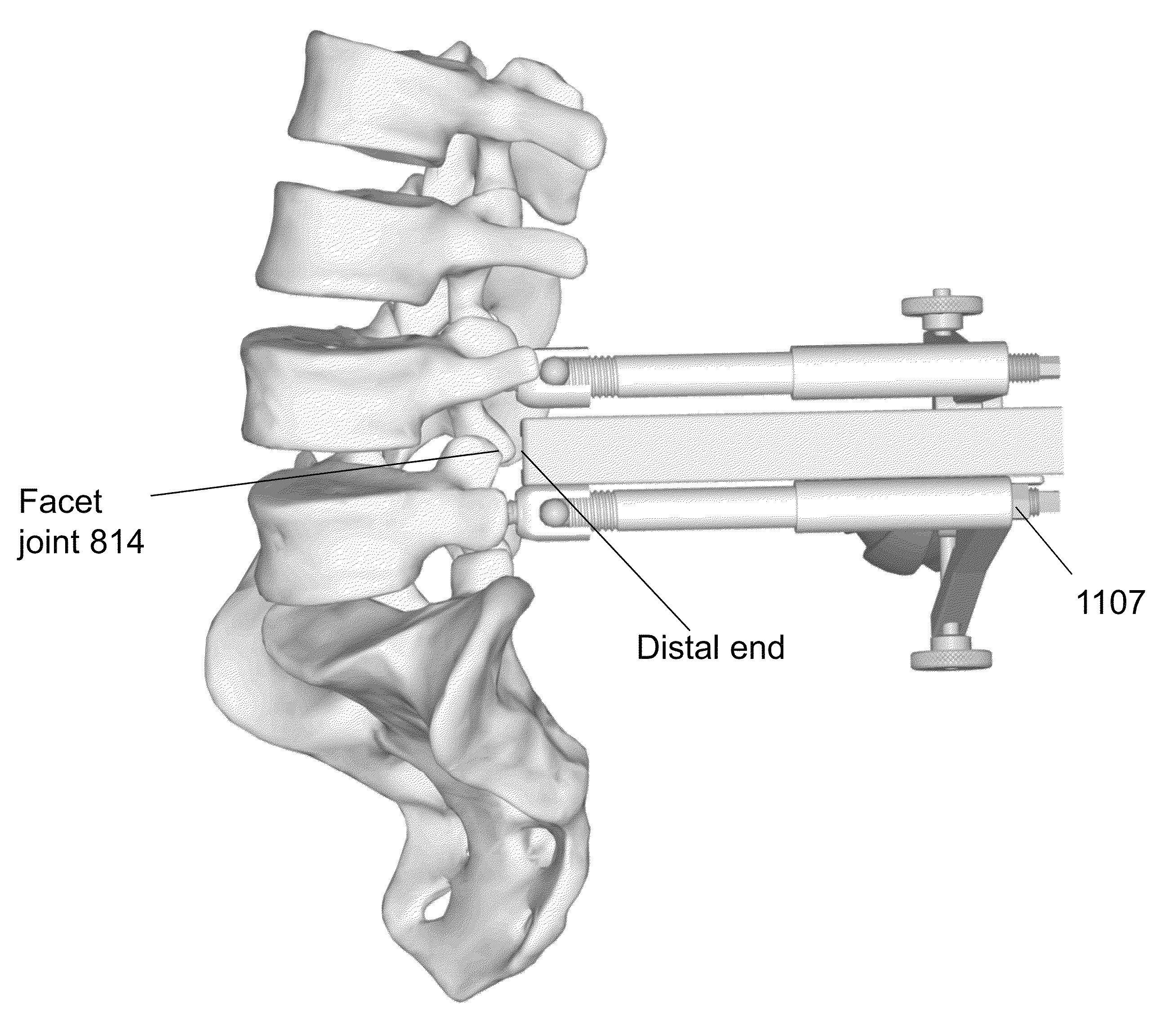 Devices and methods for minimally invasive spinal stablization and instrumentation