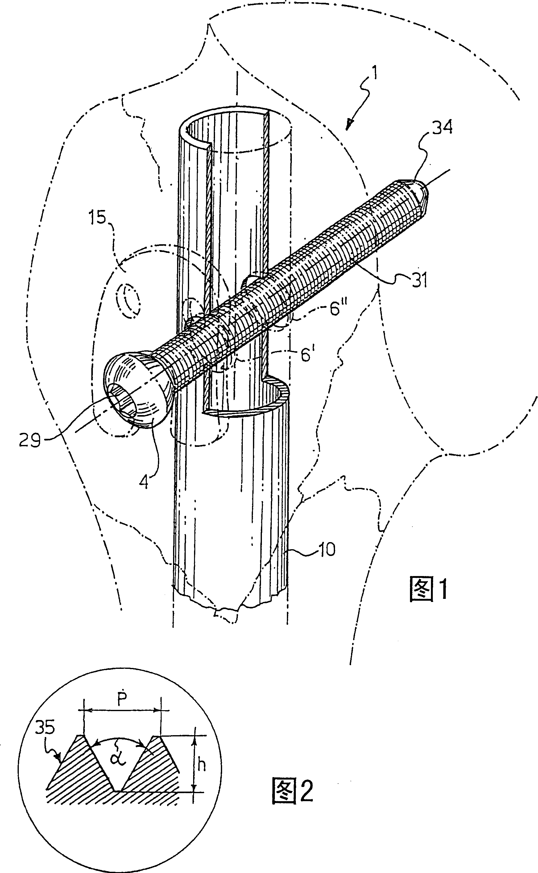Nail and screw fixation system for improving the fixation of proximal fractures of the humerus