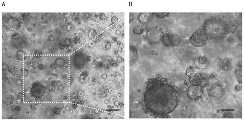 A method for establishing a xenograft tumor model derived from colorectal cancer patients based on a temperature-sensitive biogel three-dimensional culture system