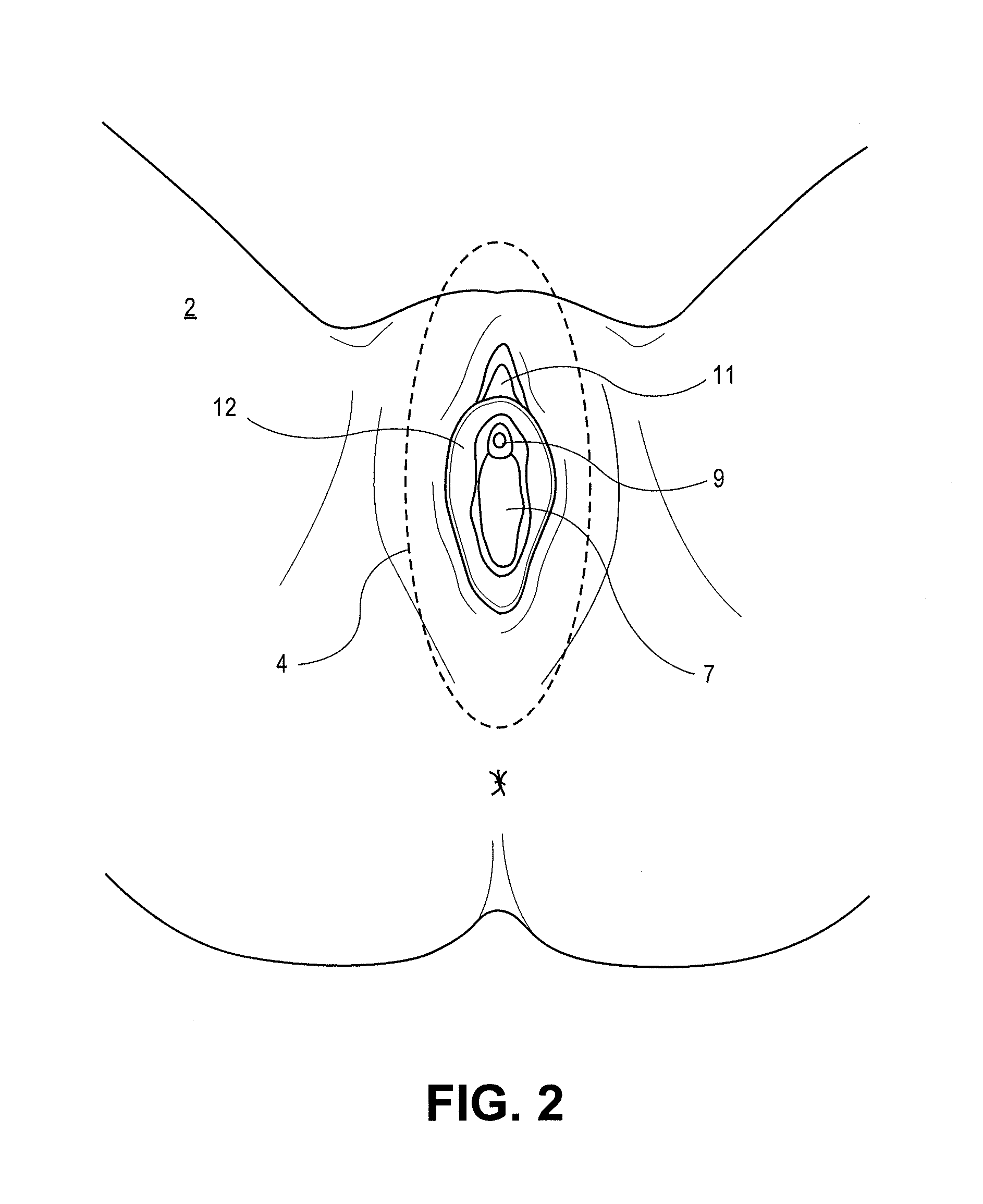 Device and method to treat vaginal atrophy