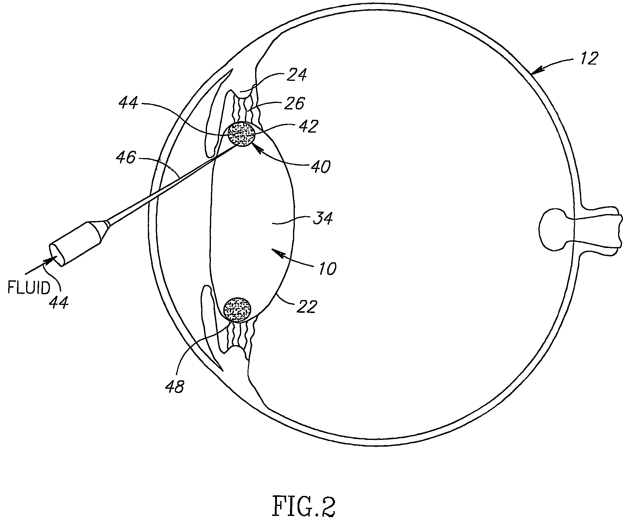Tensioning intraocular lens assembly