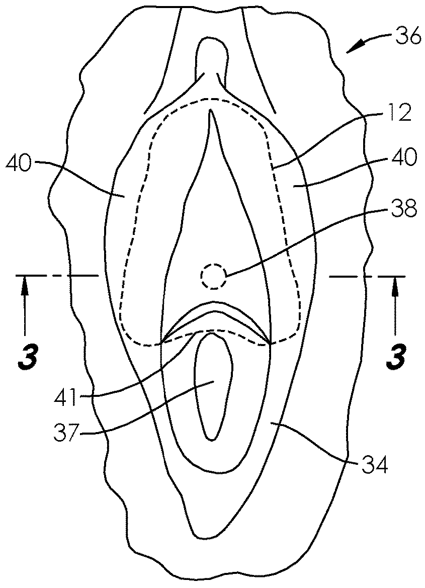 Systems and methods for incontinence control