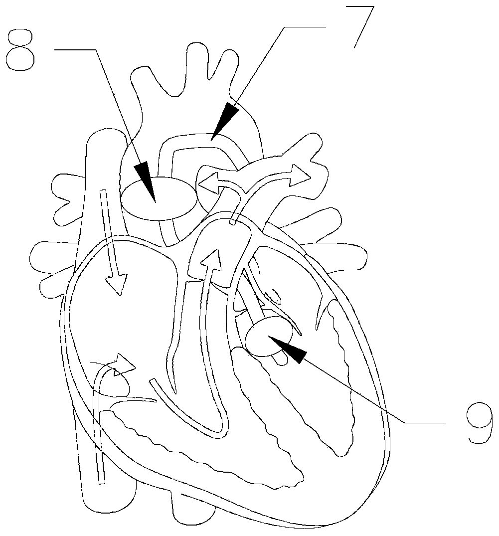 Catheter for myocardial protection liquid perfusion through percutaneous intervention